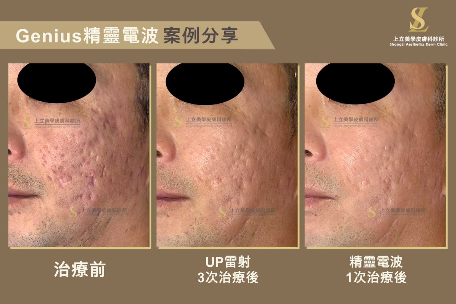 林上立醫師針對嚴重痘疤凹疤問題，使用UP雷射與Genius精靈電波來治療，幫助恢復皮膚彈性和膠原蛋白新生，讓整體膚質達到更進一步的改善和提升！