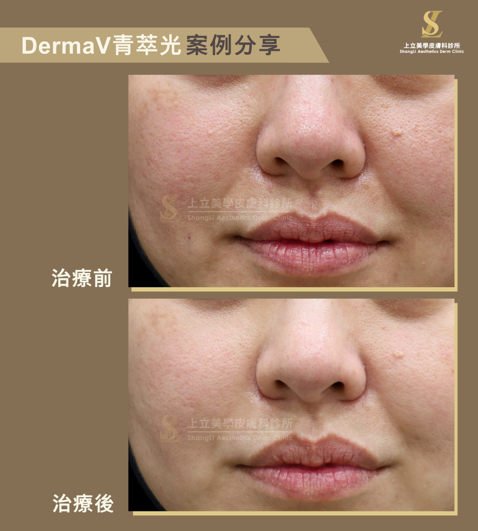 在接受DermaV青萃光治療後，不僅皮膚泛紅得到改善，也幫助控油、減少皮脂分泌，讓肌膚的細緻度、光澤感與膚色均勻度都有顯著提升。