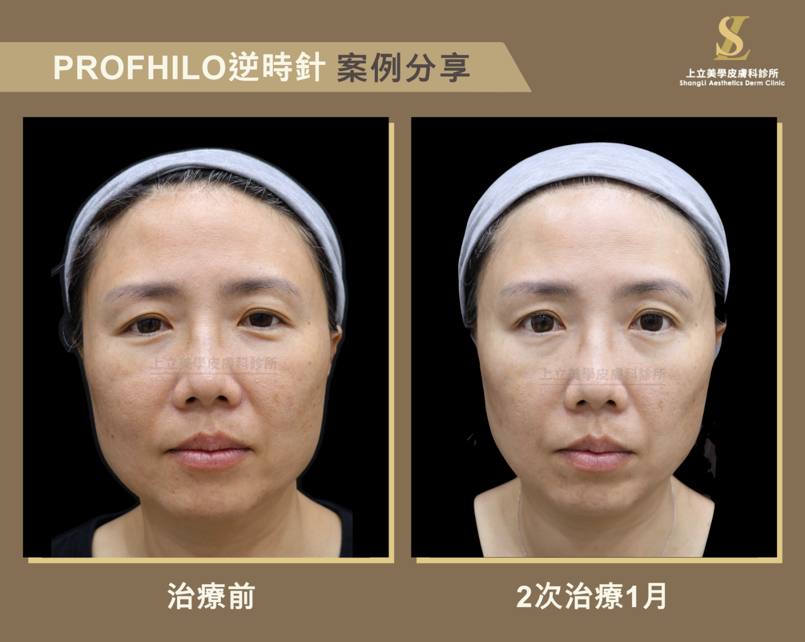 Profhilo逆時針來增加肌膚保水度