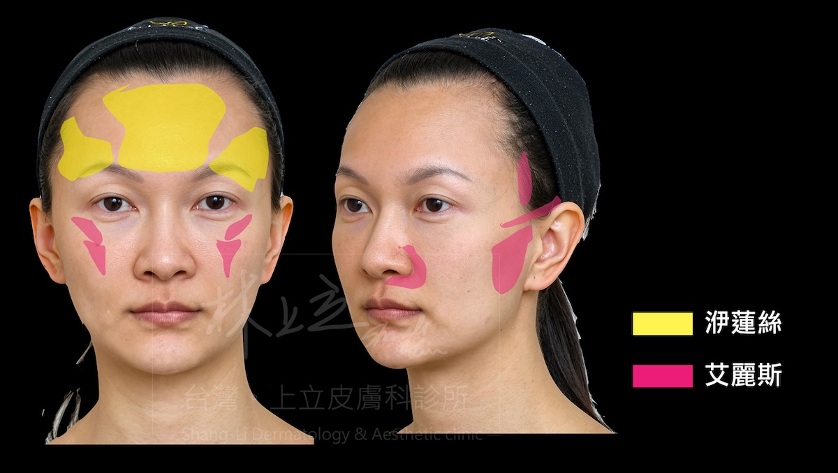 上立醫師治療案例,針對洢蓮絲和艾麗斯的差異特性,進行分區域的複合式治療