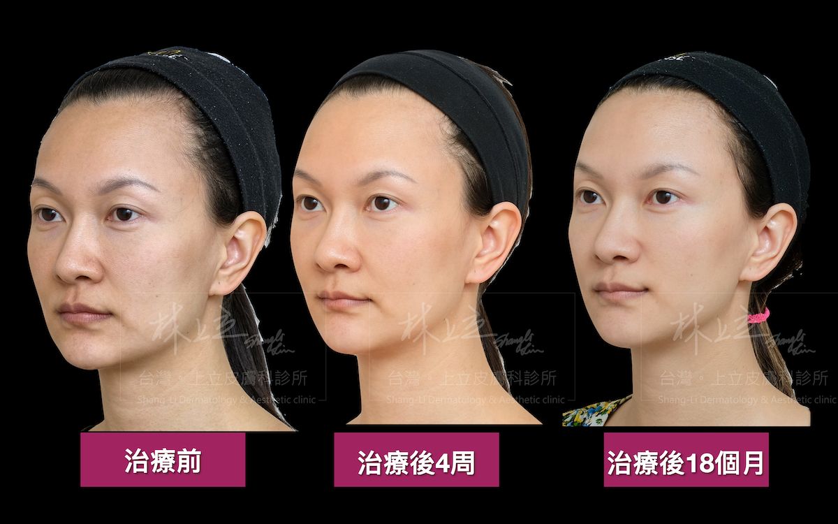 追蹤治療成效,在上立醫師治療後1.5年都仍維持不錯的治療效果,並且相較於治療前,整個人的膚質狀態和輪廓緊實度都更好,而膚質進步也是膠原蛋白增生劑的一大迷人之處。