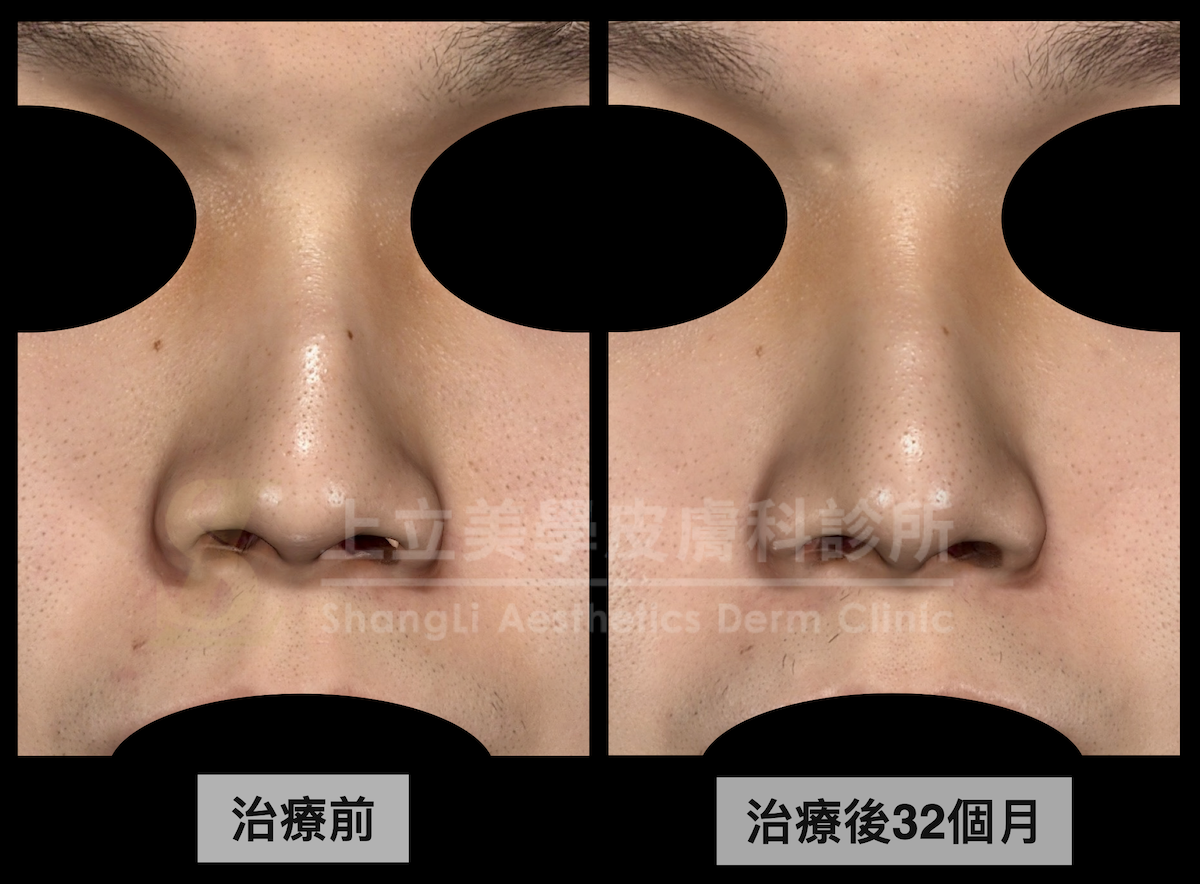 將ELLANSÉ洢蓮絲用於鼻子或額頭注射,不只能創造出近似真實骨架的觸感和立體度,甚至在治療後2、3年都還有不錯效果,並且沒有出現材質外擴或外移的狀況喔!