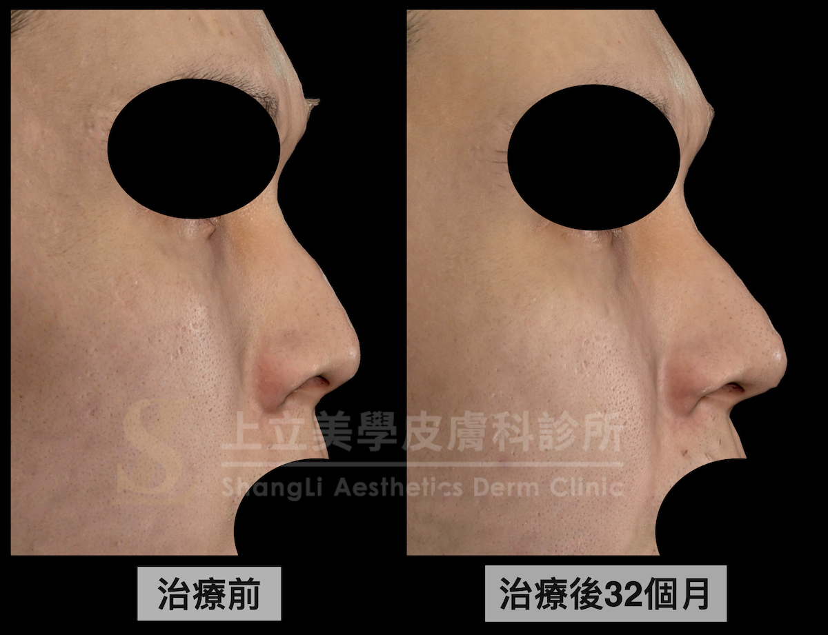 臨床觀察求診者在使用ELLANSÉ洢蓮絲-S隆鼻之後,一直到治療後32個月(2年8個月)都還維持很好的效果,並沒有出現材質外擴、外移或變形的狀況。