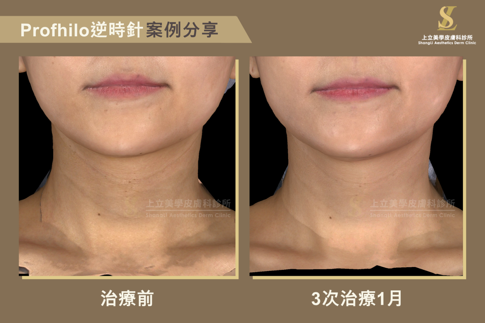林上立醫師使用Profhilo逆時針進行3次治療後，明顯改善淺層頸紋