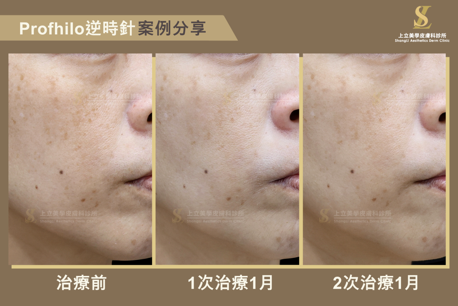 林上立在治療期間，觀察局部膚質變化發現， Profhilo逆時針在改善膚質與提亮膚色方面表現也有當顯著。