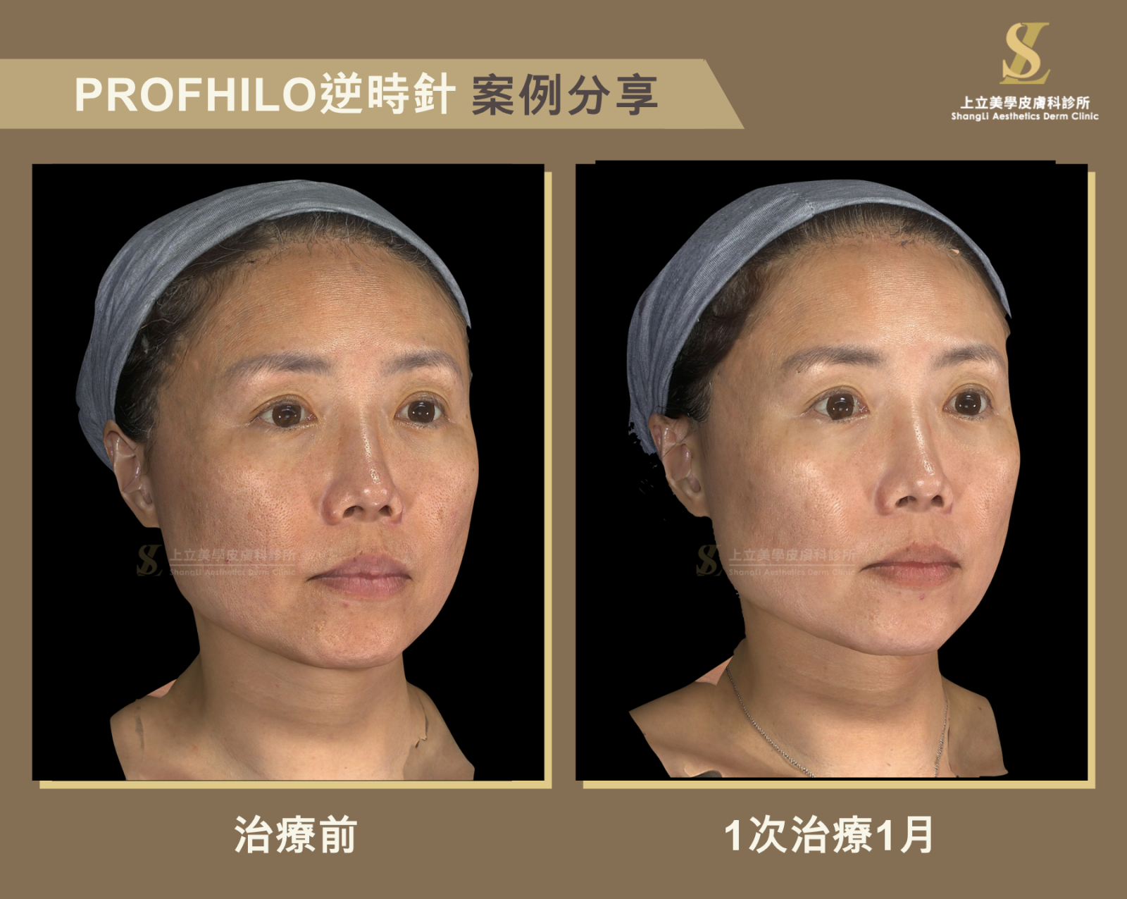 在治療後1個月時，膚色比治療前更均勻透亮，肌膚亮度與光澤感提升，毛孔與細紋也明顯減少，整體膚質更細緻平滑。並在進入第2個月後，整體效果持續進步，肌膚緊緻度與彈性進一步提升。
