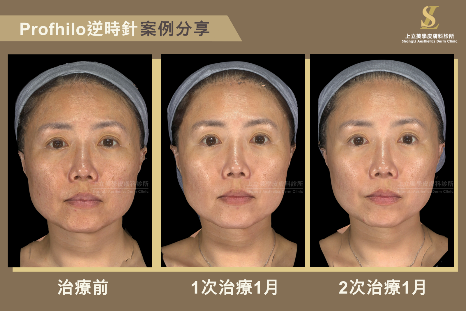 在治療後1個月時，膚色比治療前更均勻透亮，肌膚亮度與光澤感提升，毛孔與細紋也明顯減少，整體膚質更細緻平滑。並在進入第2個月後，整體效果持續進步，肌膚緊緻度與彈性進一步提升。