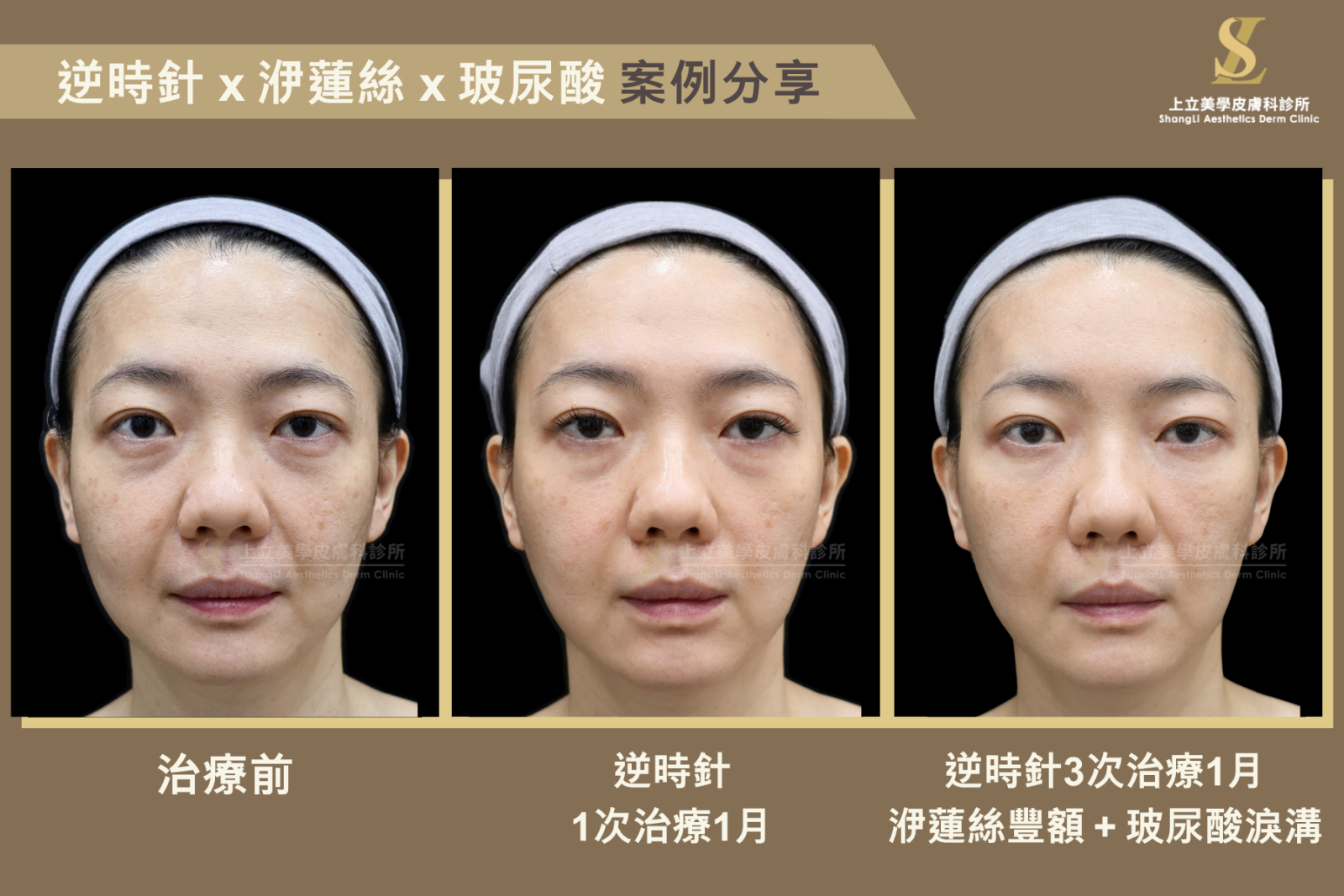林上立醫師使用逆時針與洢蓮絲的複合運用，Profhilo逆時針淡化陰影，而注射洢蓮絲增加上臉的飽滿度和平順感，讓視覺效果更加分！