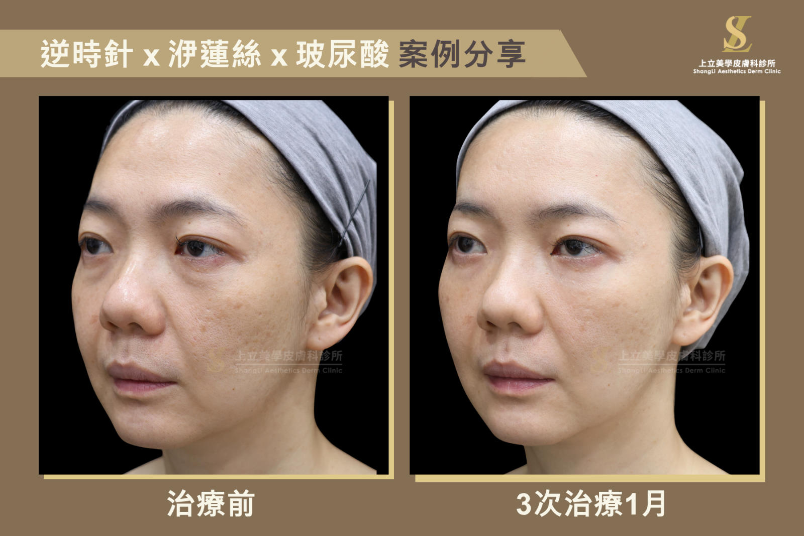 林上立醫師使用逆時針與洢蓮絲的複合運用，Profhilo逆時針淡化陰影，而注射洢蓮絲增加上臉的飽滿度和平順感，讓視覺效果更加分！