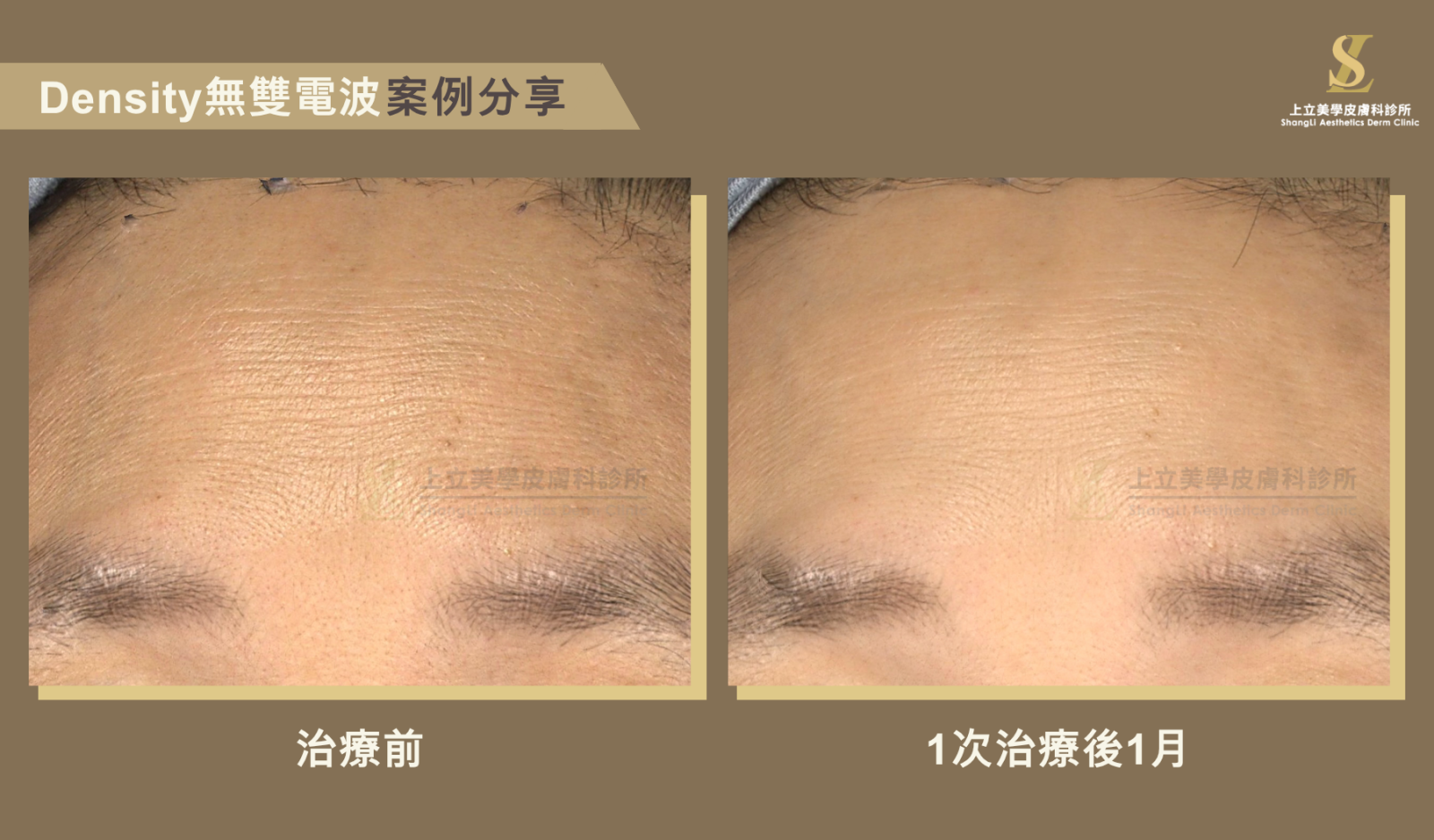 林上立醫師的無雙電波案例治療，在DENSITY無雙電波治療後1個月，額頭紋路比治療前已有明顯改善也更細緻。