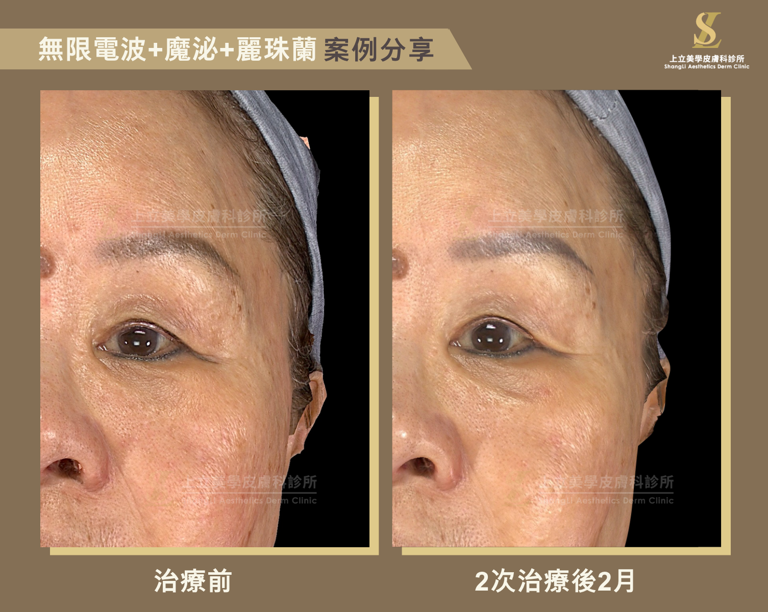 林上立醫師案例分享，使用POTENZA無限電波搭配麗珠蘭、魔泌（外泌體）的二次治療後，不僅皮膚泛紅的狀況改善不少，整體皮膚的細緻度和光澤感也有明顯提升，就連原先略顯鬆弛的眼周肌膚也變得緊實、眼尾也拉提了