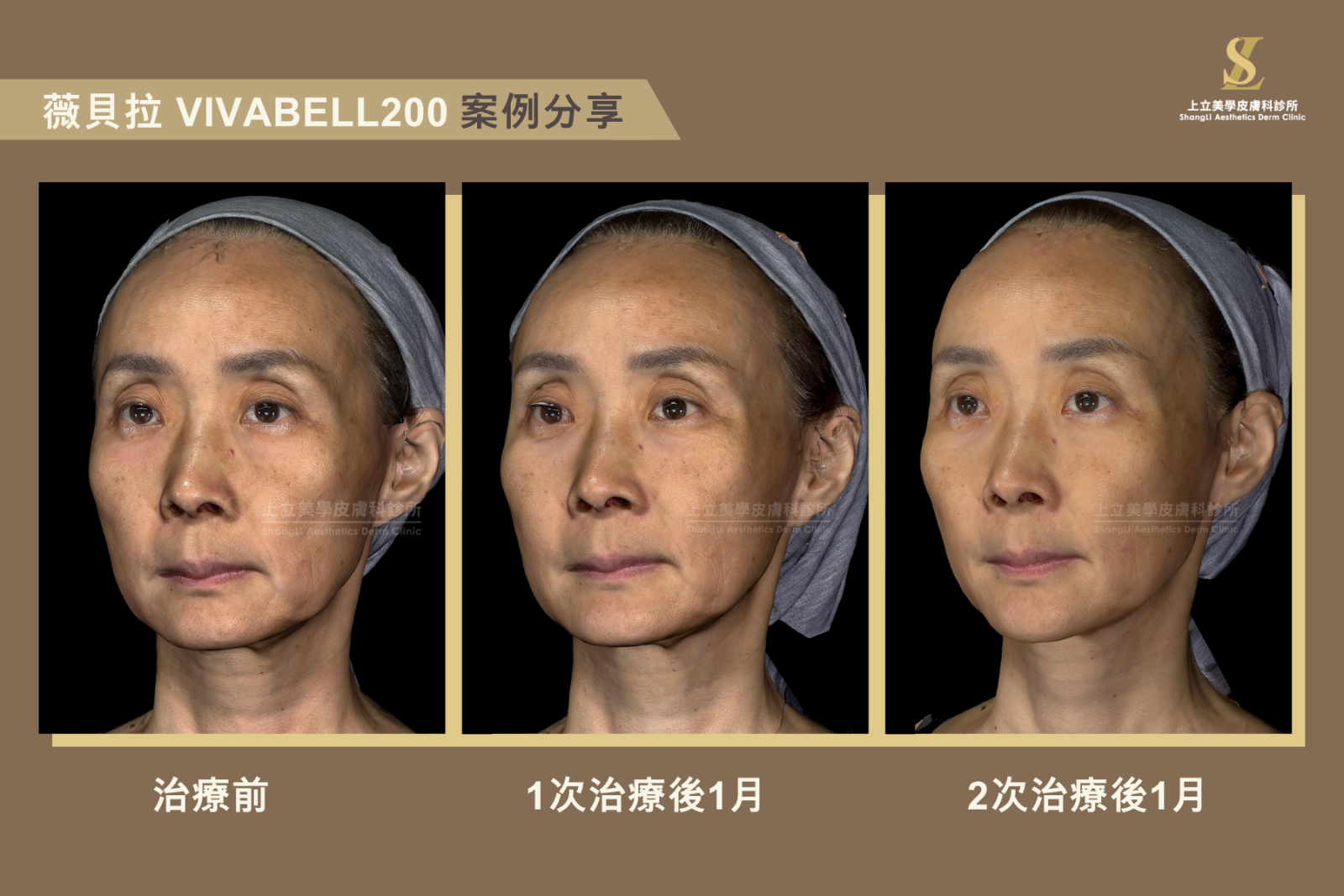 大分子薇貝拉(VIVABELLA200,黑童針)的分子較大,有較好的支撐性,可用於建立深層支撐,改善深層流失所產生的紋路、凹陷和臉部鬆弛下垂的情況。