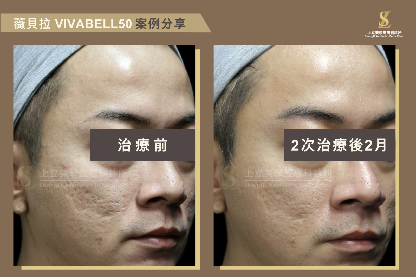 小分子薇貝拉的分子較小,可用於淺層組織的注射來改善膚況,不只原先臉部痘疤變淺了,就連皮膚也感覺更加細緻有光澤。