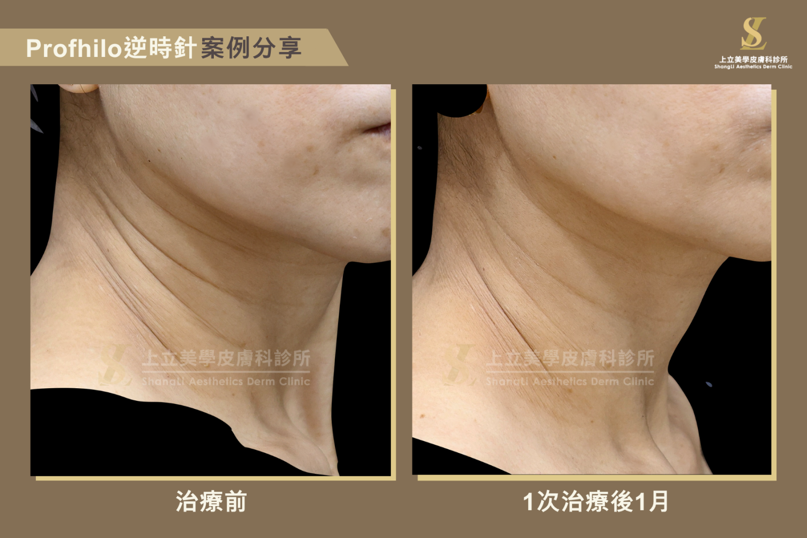 PROFHILO逆時針可以啟動膠原蛋白與彈力蛋白修復能力