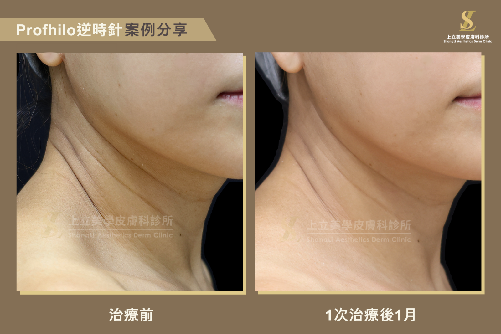 PROFHILO逆時針不會增加體積，但能啟動膠原與彈力蛋白的修復能力，幫助維持組織張力