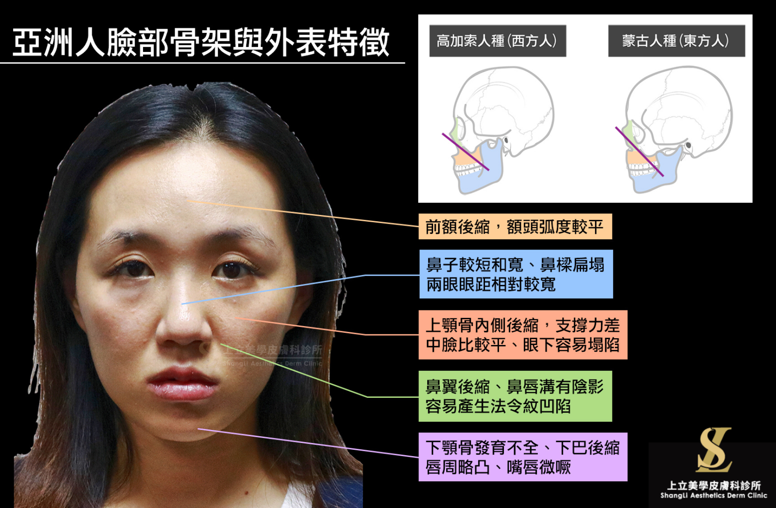 亞洲人臉部骨架的中臉支撐較差