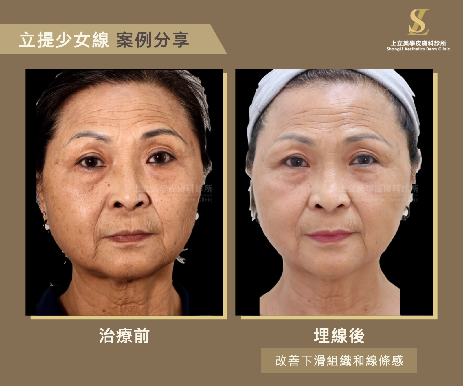 當年齡漸長，深層脂肪和骨架已出現嚴重體積減少