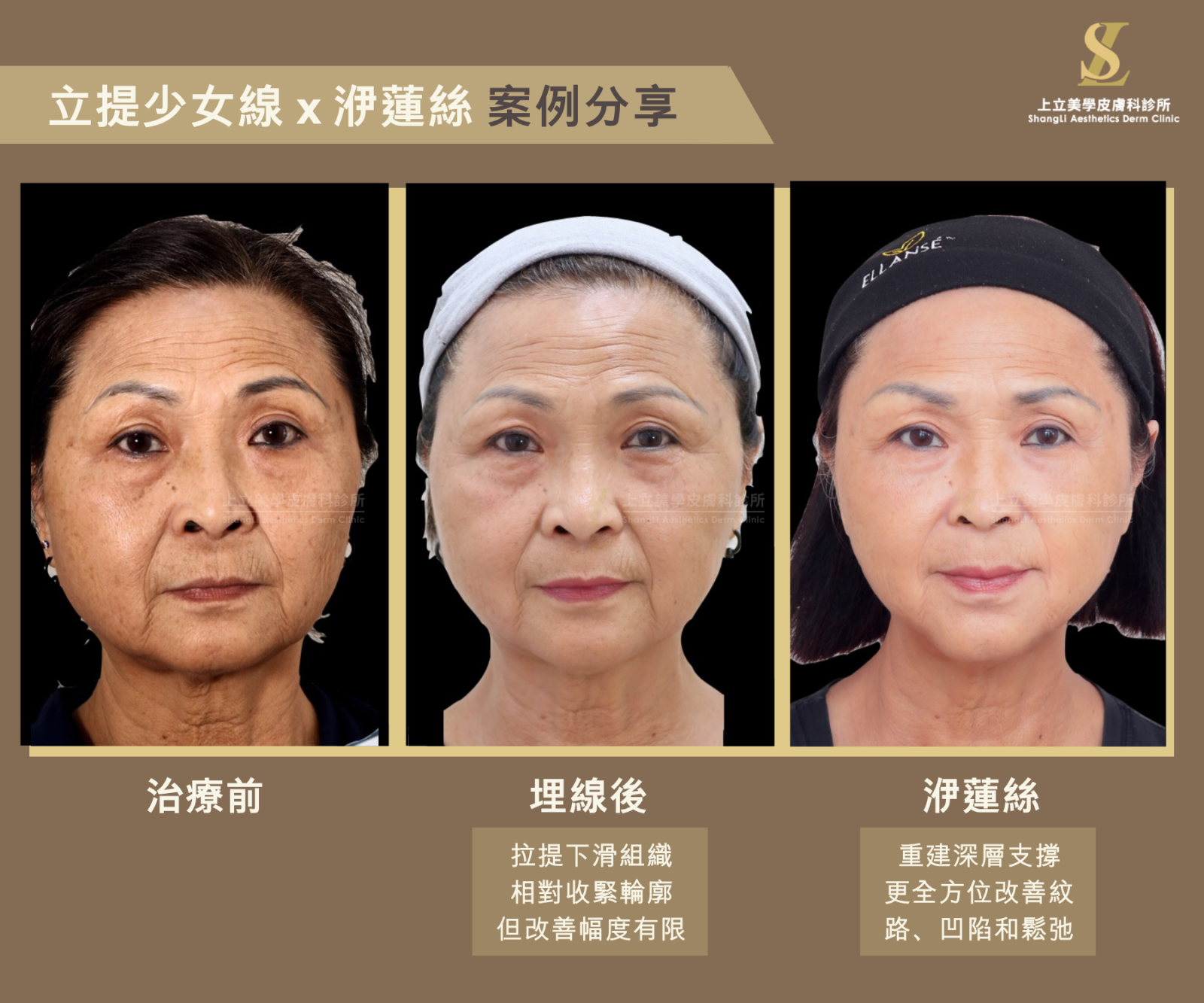 注射型醫美／液態拉皮➔淺層填補、深層支撐，全方位改善法令紋