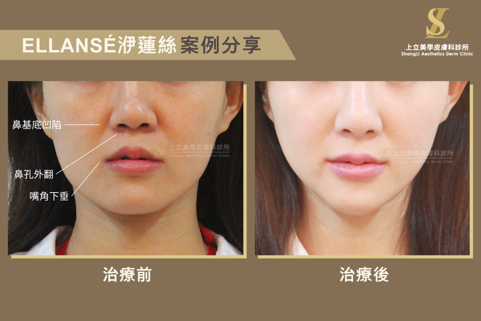 面對典型的亞洲人輪廓（中臉比較平、鼻唇溝凹陷）