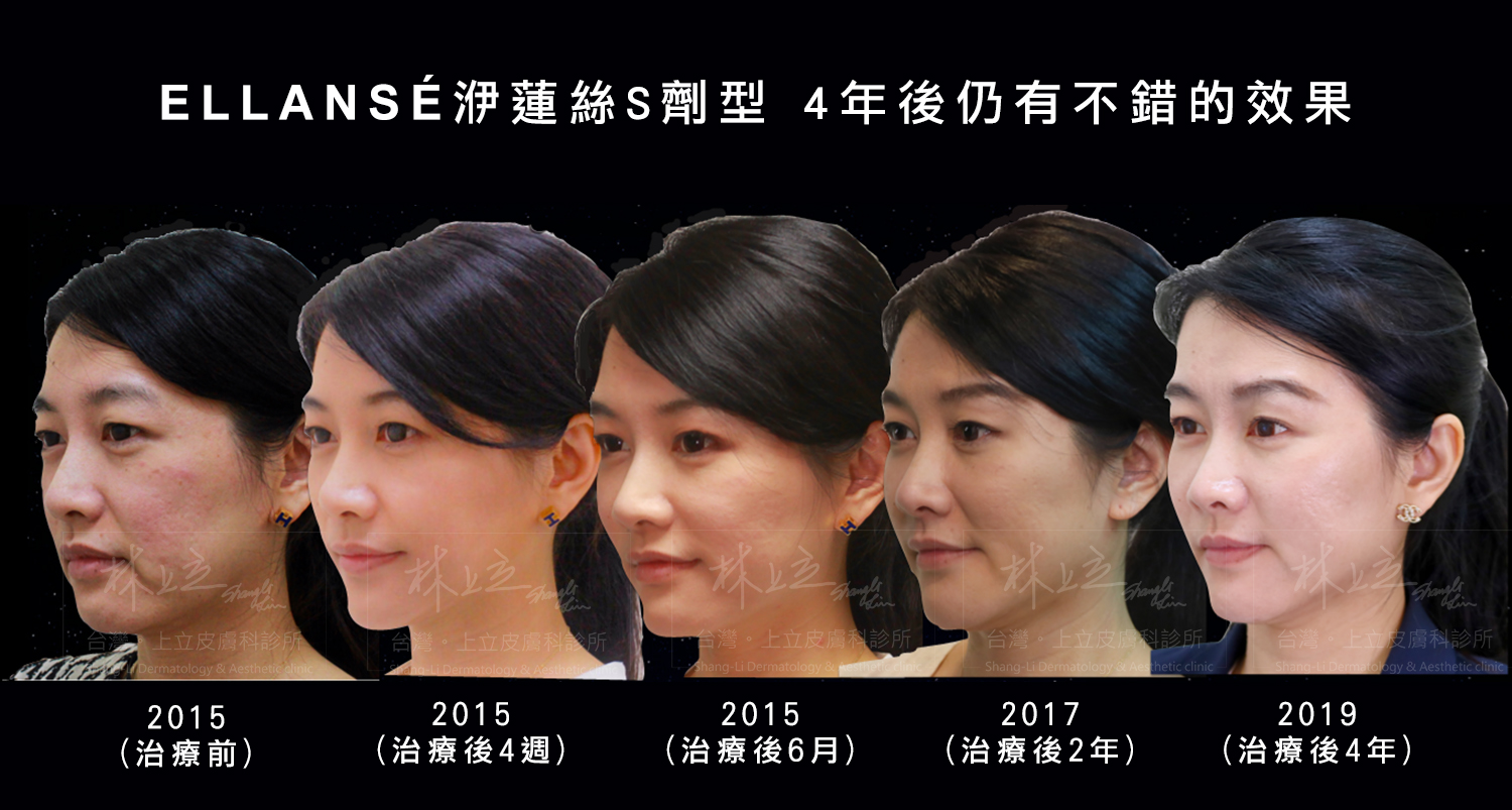 根據診所的追蹤觀察， 施打完ELLANSÉ洢蓮絲S劑型的的術後4年，效果仍持續很好。