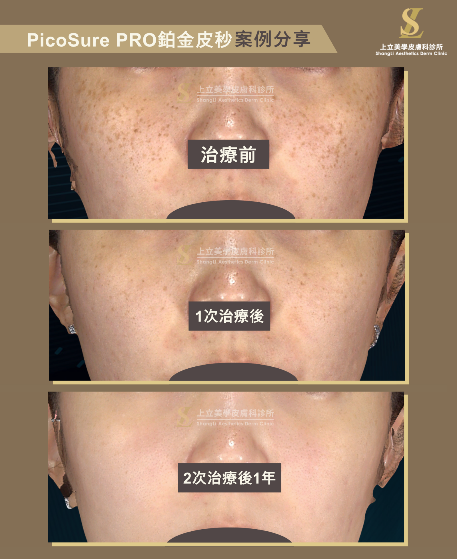 上立美學案例，PicoSure PRO鉑金蜂巢皮秒雷射治療一次後，鼻子與兩頰斑點已有大幅改善，經過２次治療的1年後變得細緻無瑕