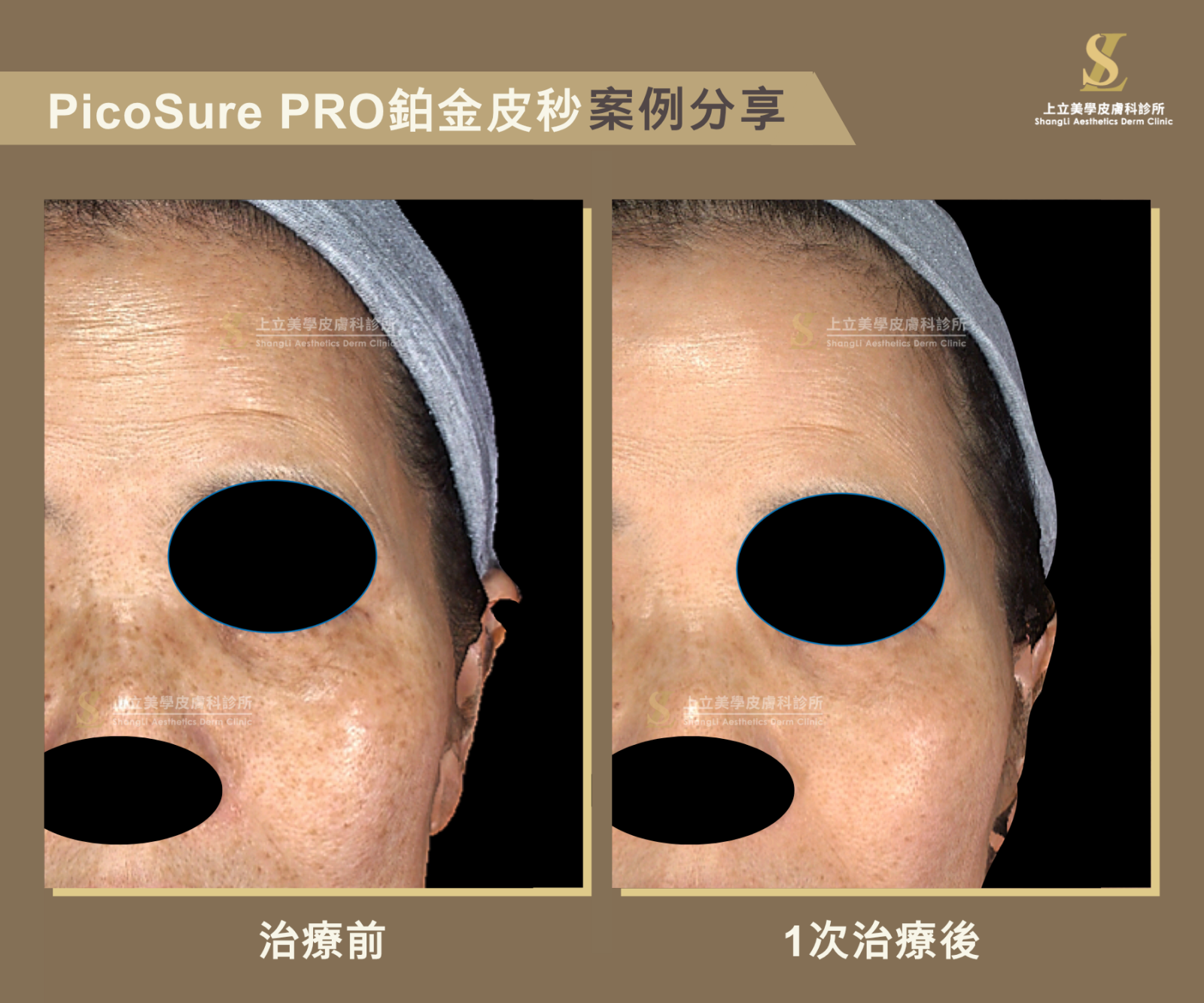 PicoSure755蜂巢皮秒雷射1次治療後，不僅臉頰上的斑點與暗沈膚色都有所改善