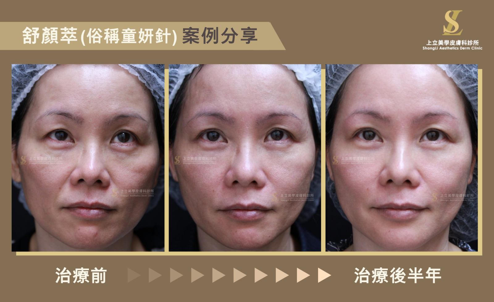 全臉緊緻拉提年輕化,術後兩年半治療效果