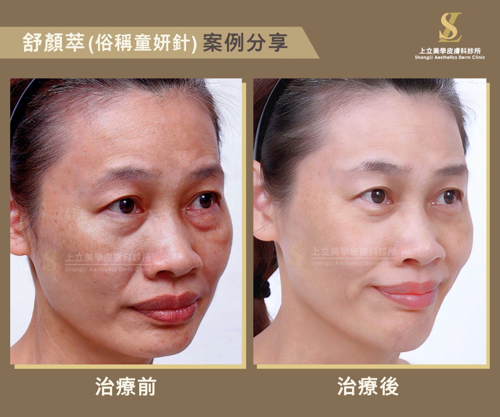 改善中下臉下垂與明顯紋路