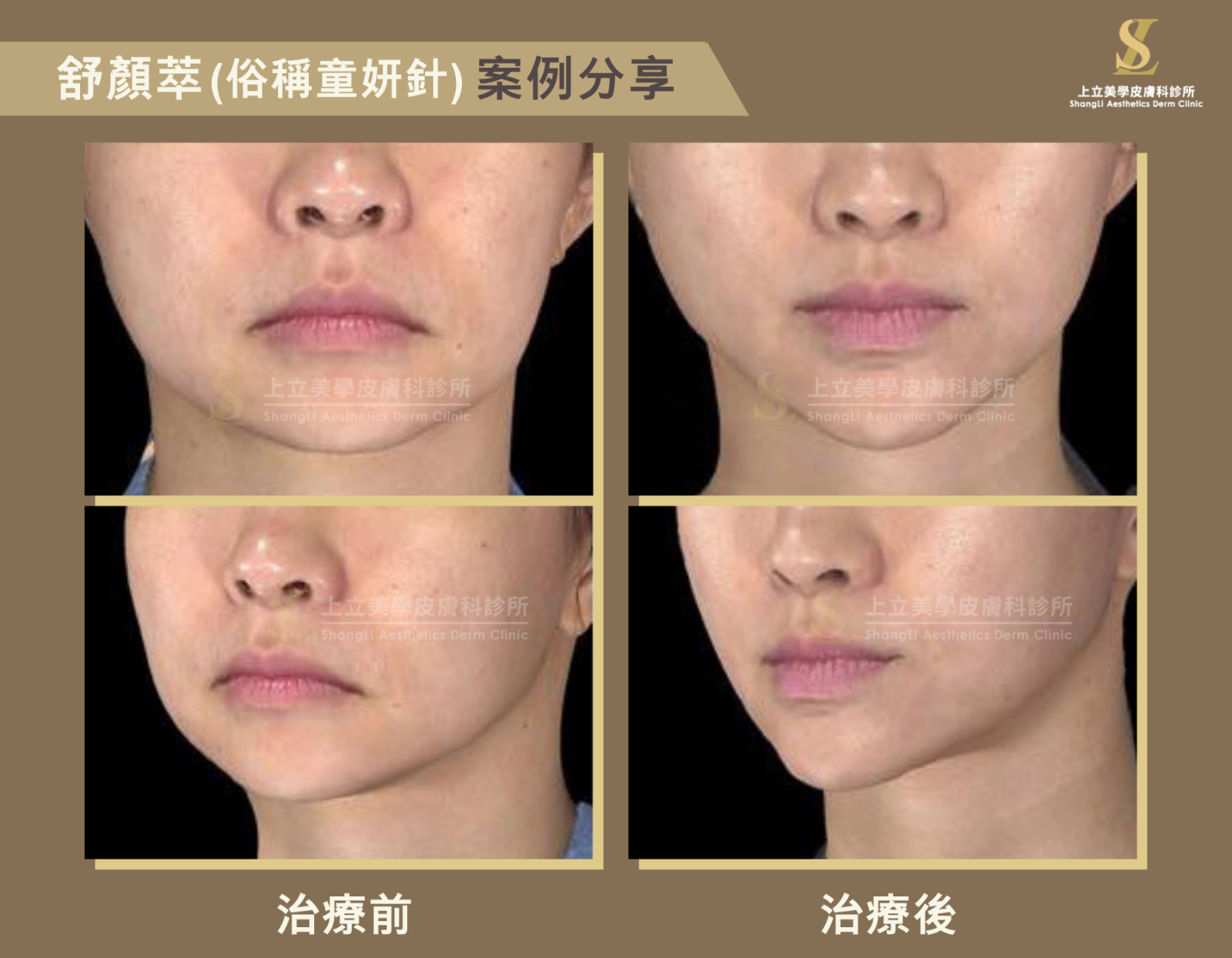 兩頰拉提與下巴雕塑