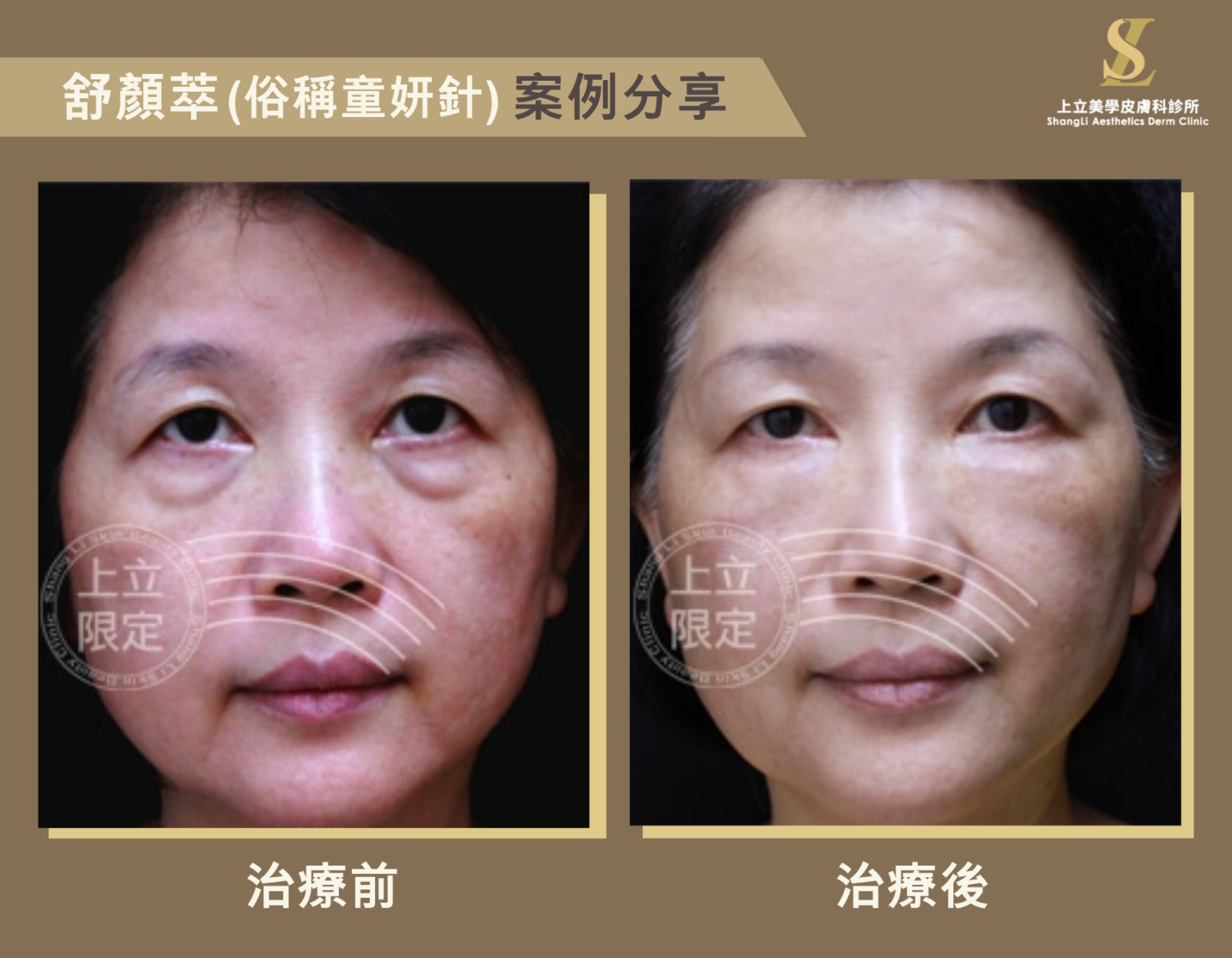 全臉緊緻拉提年輕化