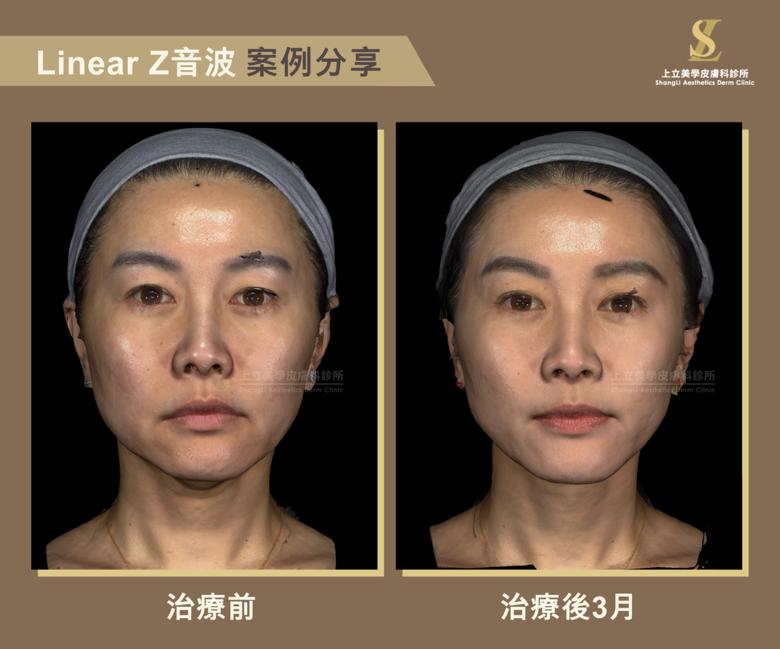 上立醫師的Linear Z音波案例，治療3個月後，從正面看起來下顎線更俐落