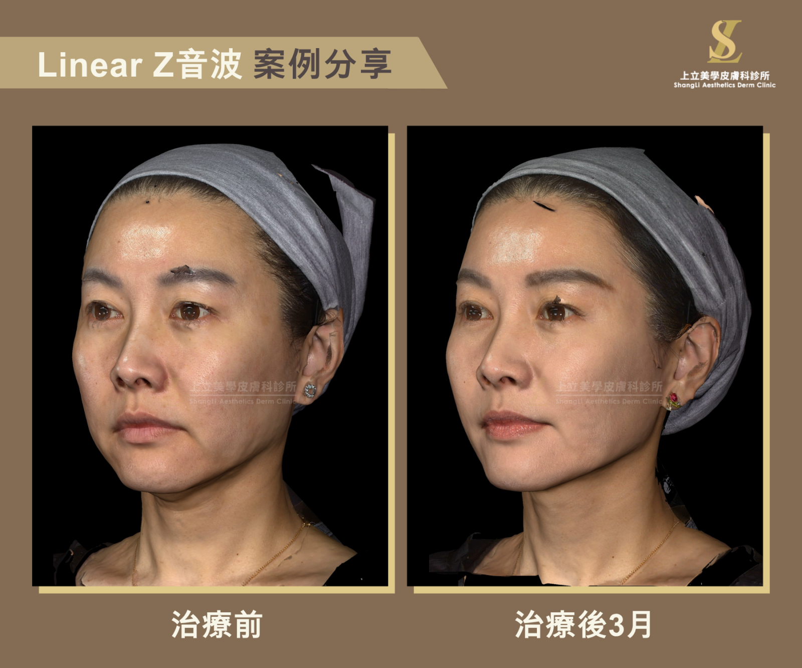 上立醫師的Linear Z音波案例，治療3個月後法令紋、木偶紋變淡