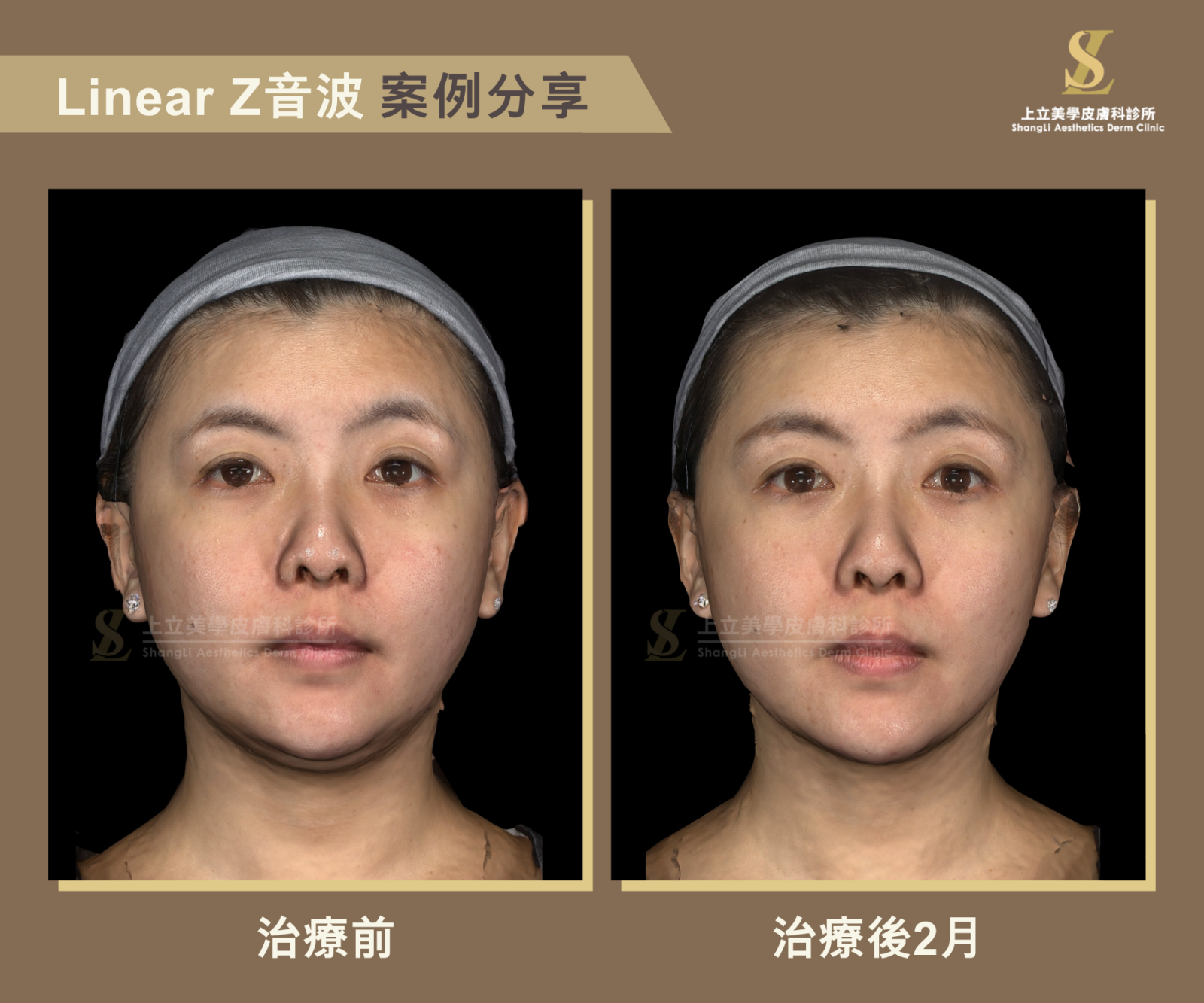 上立醫師使用Z音波進行治療，改善下臉鬆弛，並平衡二邊眉毛高度，雙下巴也變不見了
