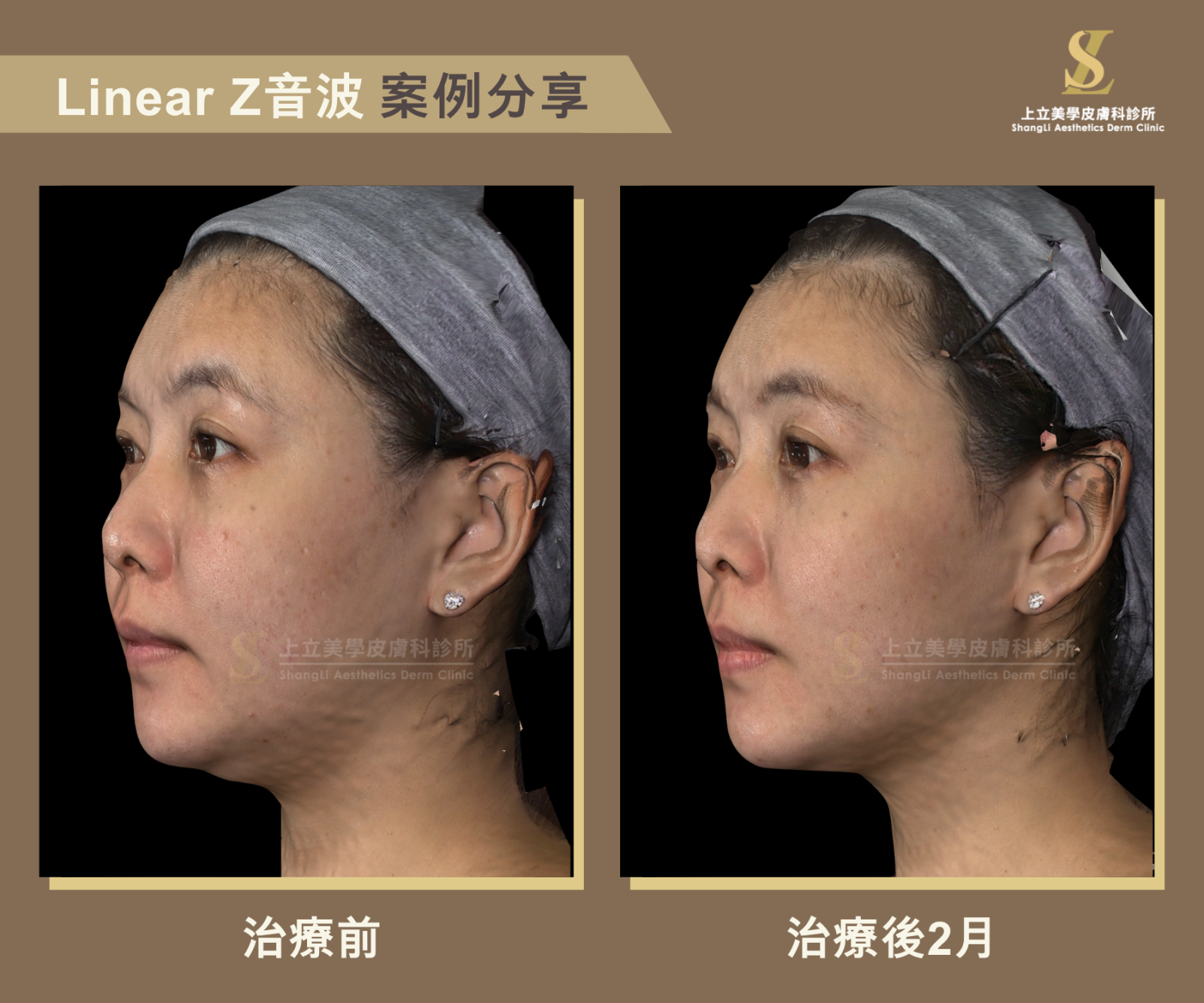 上立醫師使用Z音波進行治療，側面看起來下顎線更俐落，下巴變尖，臉變小