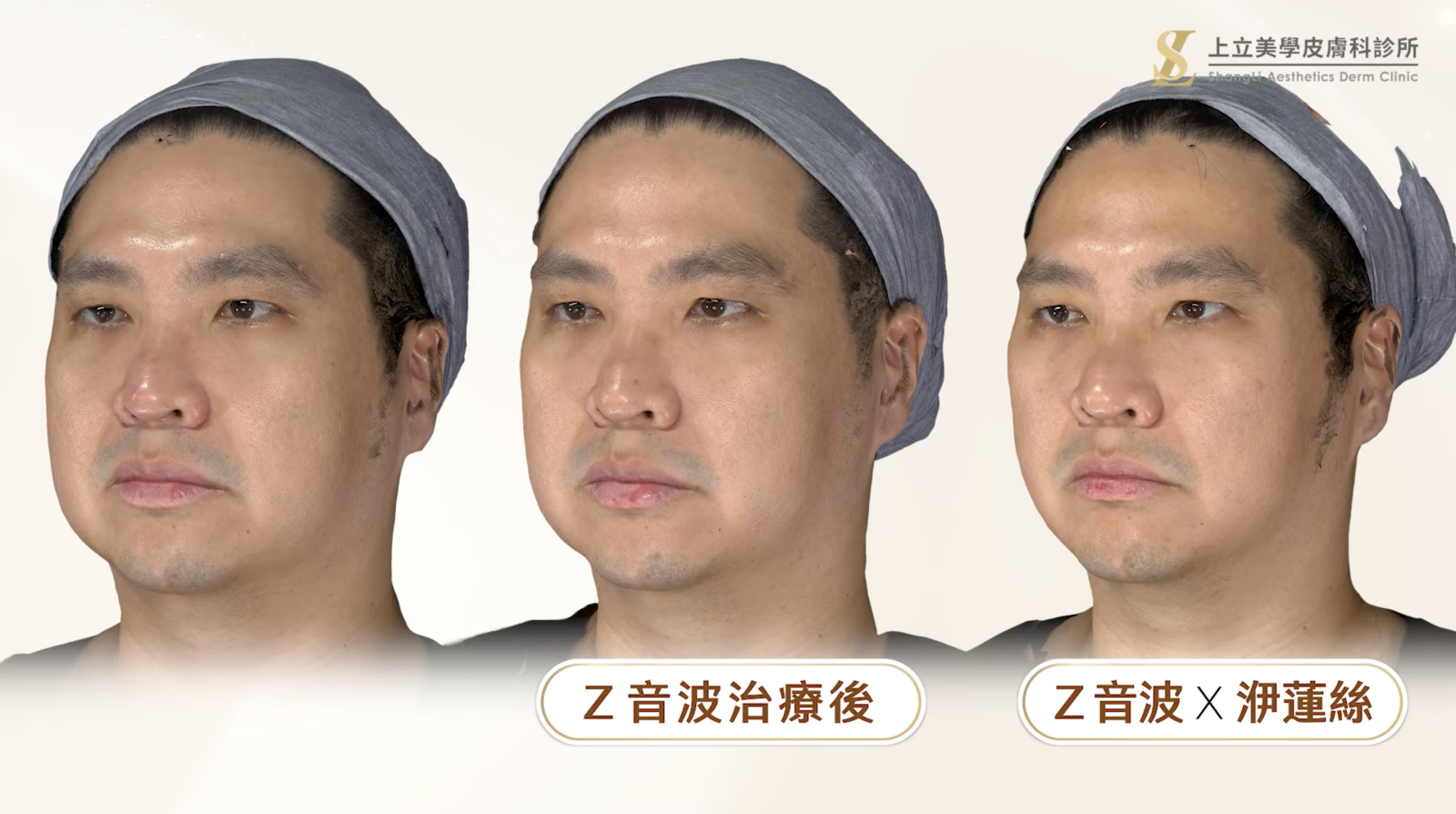 「注射＋音波」治療