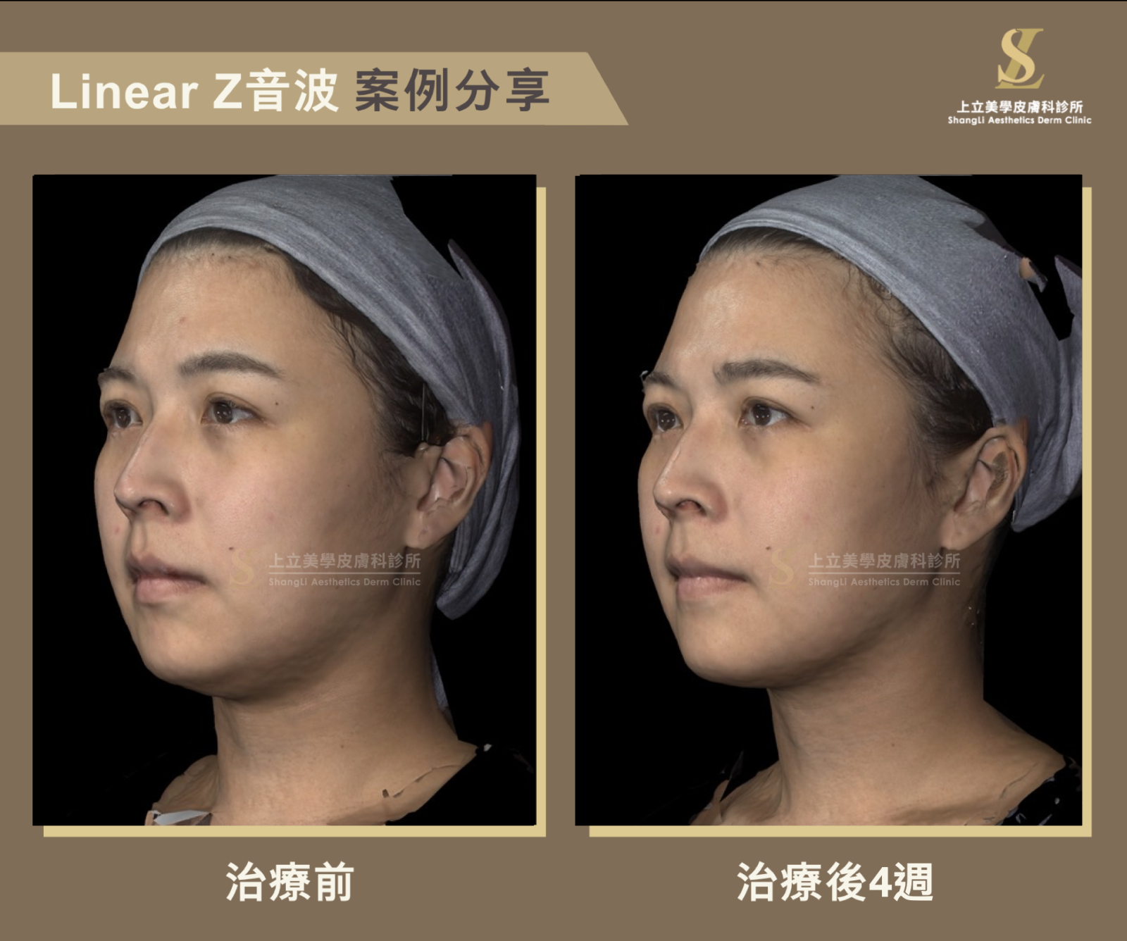 上立醫師使用LinearZ音波治療4週後，明顯改善雙下巴的厚重脂肪，雙下巴變不見了