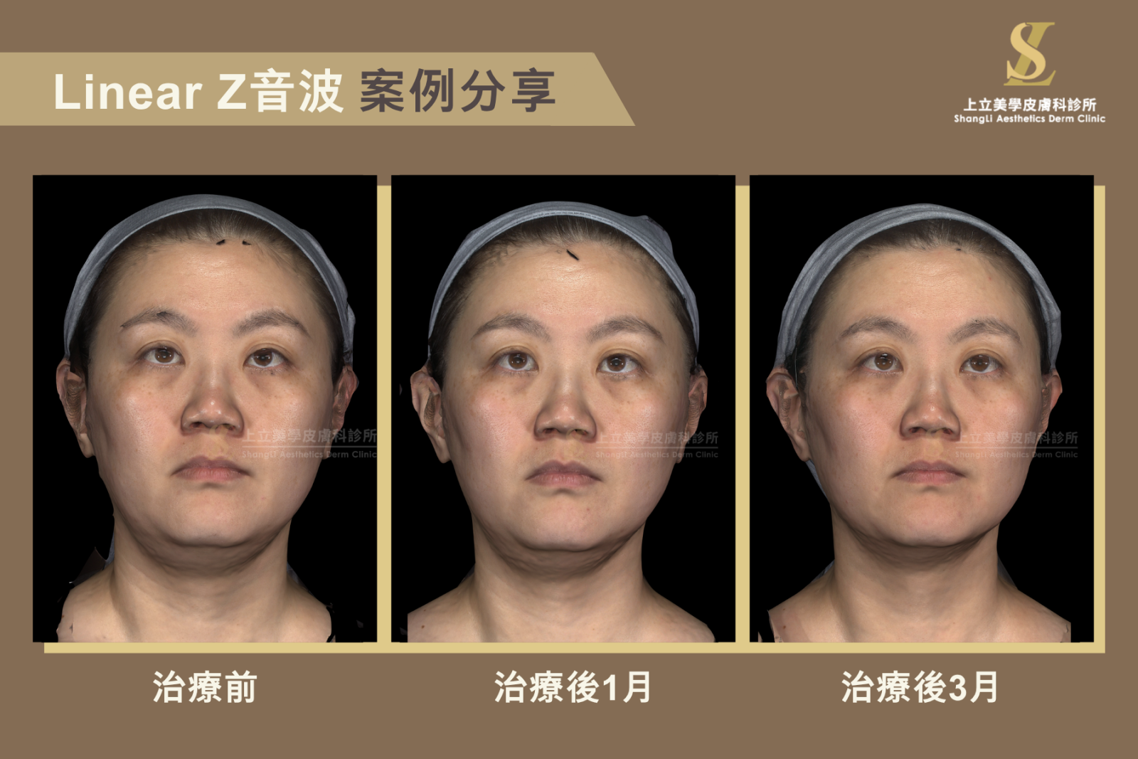 上立醫師使用LinearZ音波治療，經過3個月後效果最好，下臉緊實＋脂肪雕塑