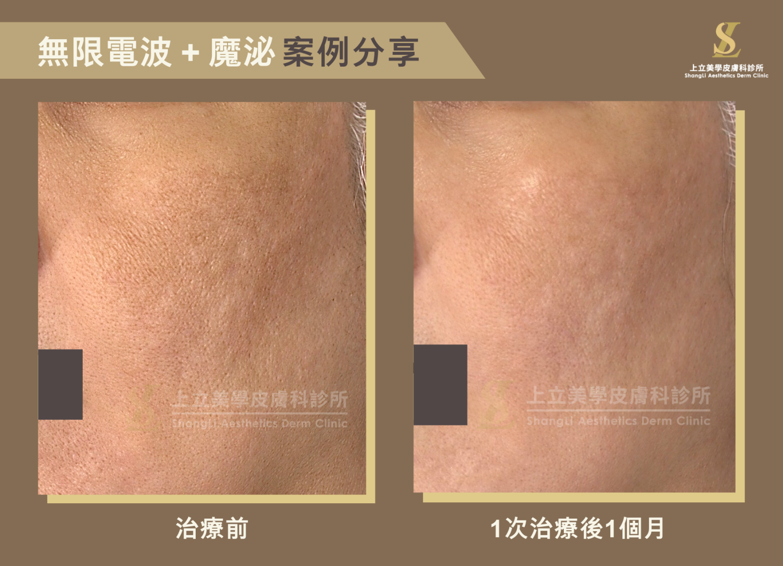 上立醫師案例，使用無線電波與外泌體治療，一次治療後的1個月，整體皮膚的進步卻更加顯著，不僅毛孔大幅縮小，膚質更細緻有光澤，就連眼下區域的一些細小紋路也有不小的改善。