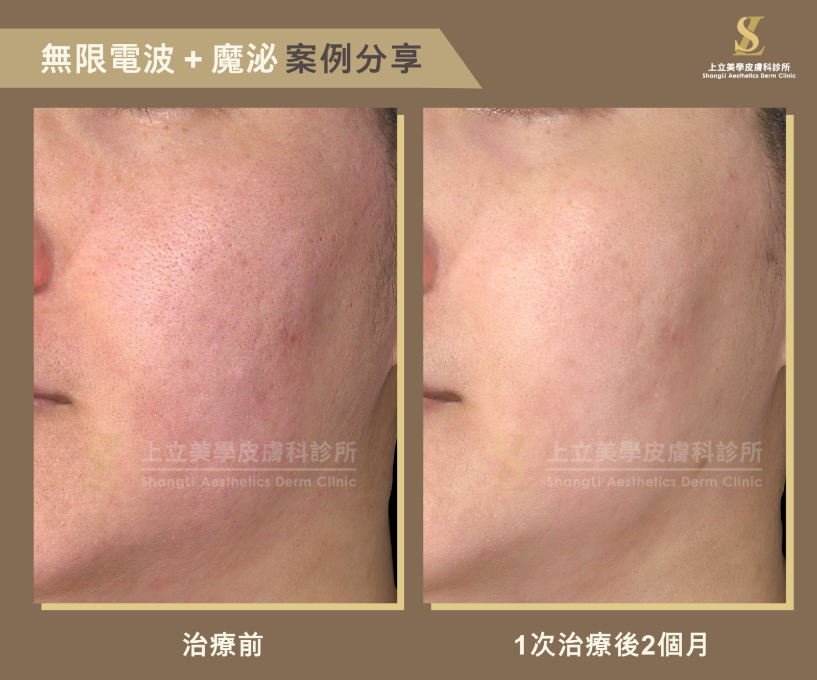 林上立醫師採用「無限電波」與「外泌體」來治療