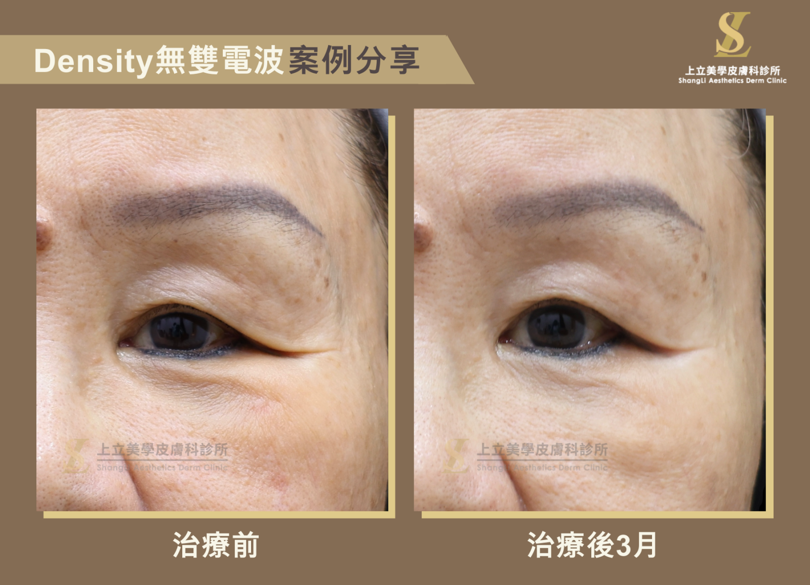 上立醫師用Density無雙電波治療眼周，在治療後3個月能顯現出最明顯的改善效果