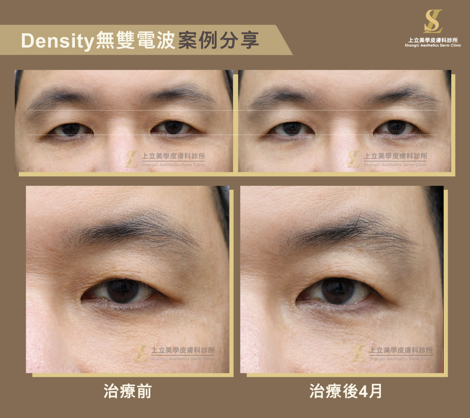 林上立醫師利用Density無雙電波治療後3~4個月出現，讓眼周肌膚更緊實、皺紋減少，同時調整雙眼與眉毛的高度，讓眼睛更平衡。