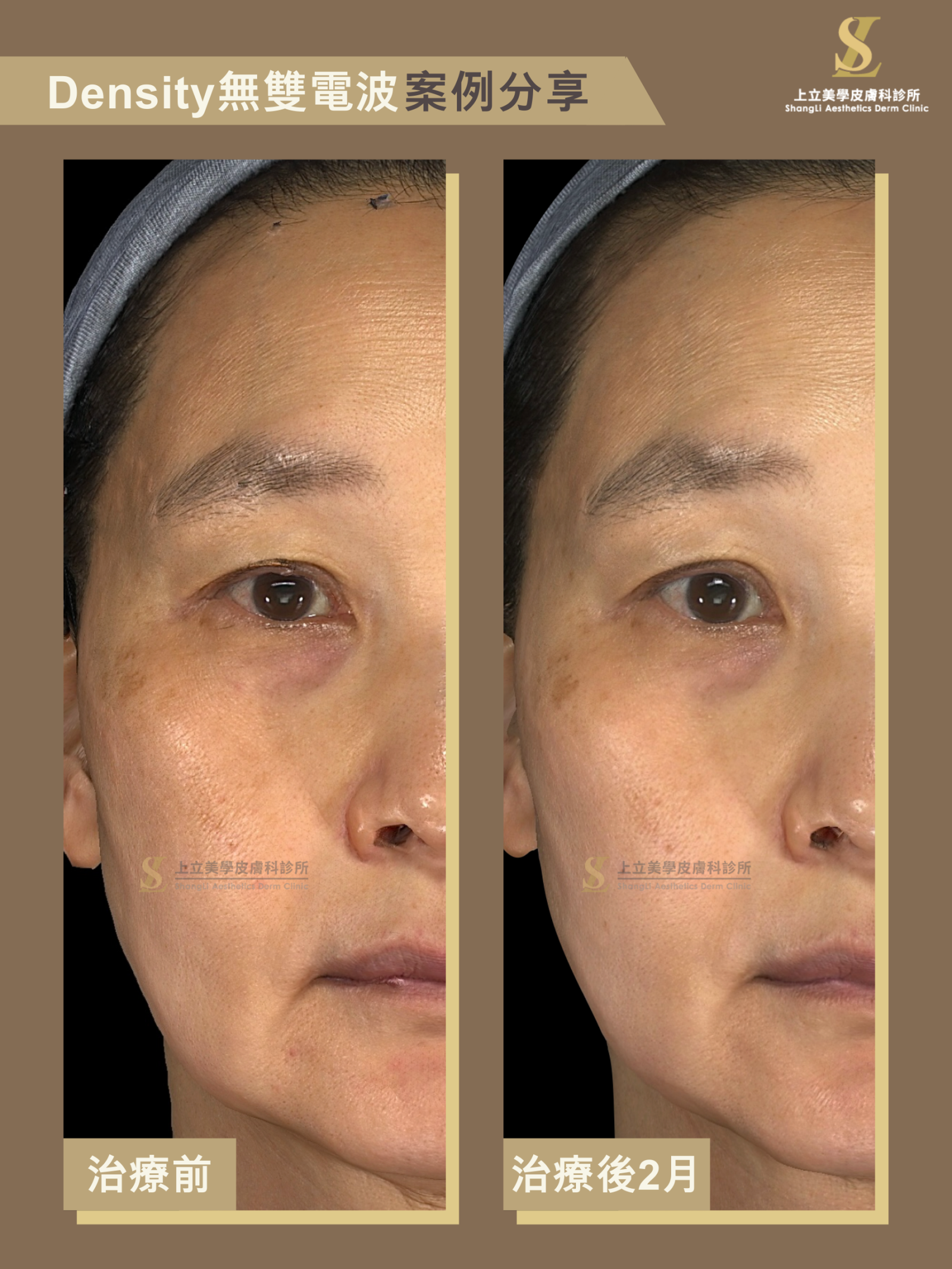 Density 無雙電波以單極＋雙極深淺同時作用，讓輪廓更緊緻上提、膚質更透亮。眼周眉眼線條上提更有神，雙眼皮摺線重現，整體更年輕亮眼。