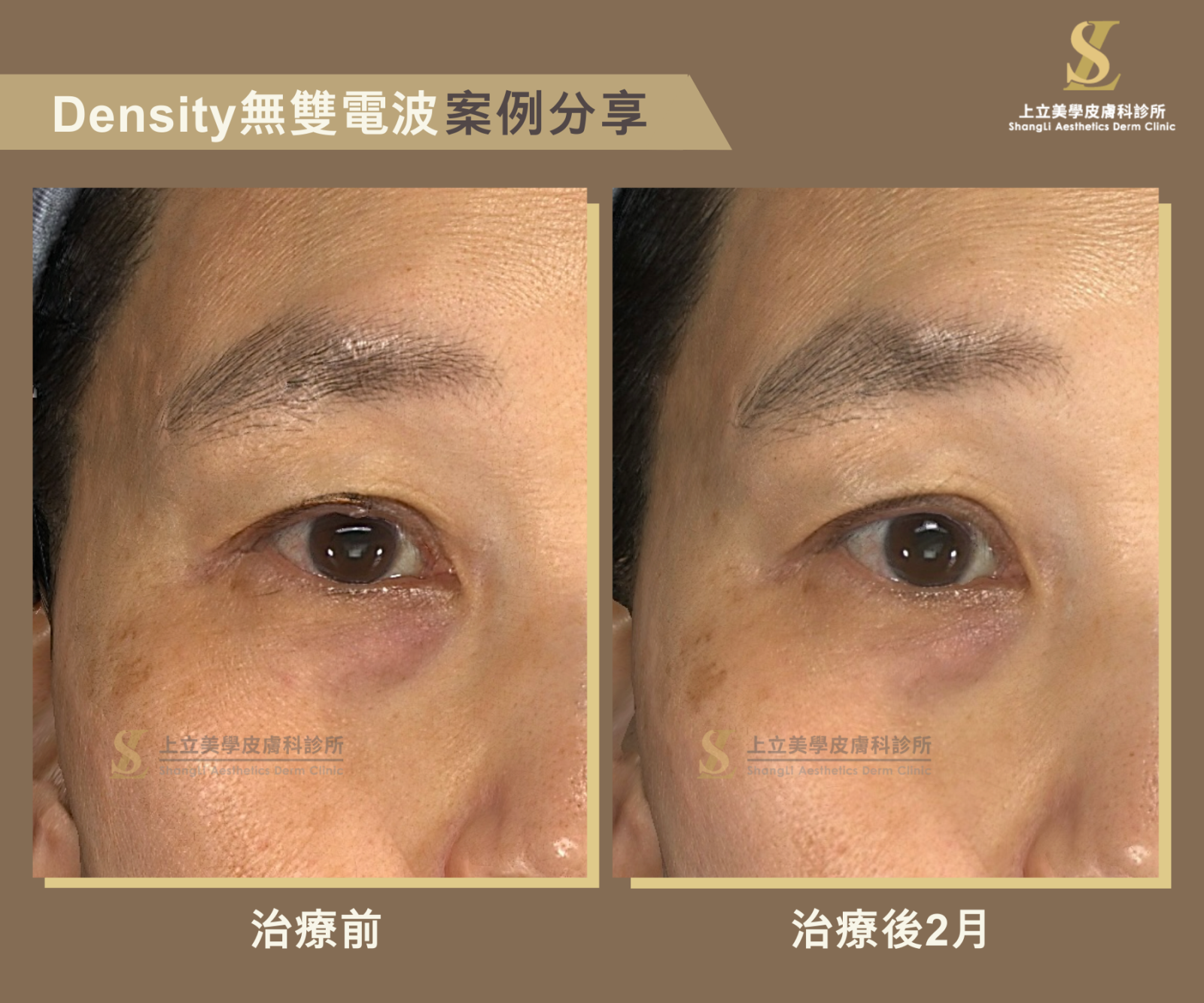 治療後2個月的臉部狀態，眼周眉眼線條上提更有神，雙眼皮摺線重現，整體更年輕亮眼。