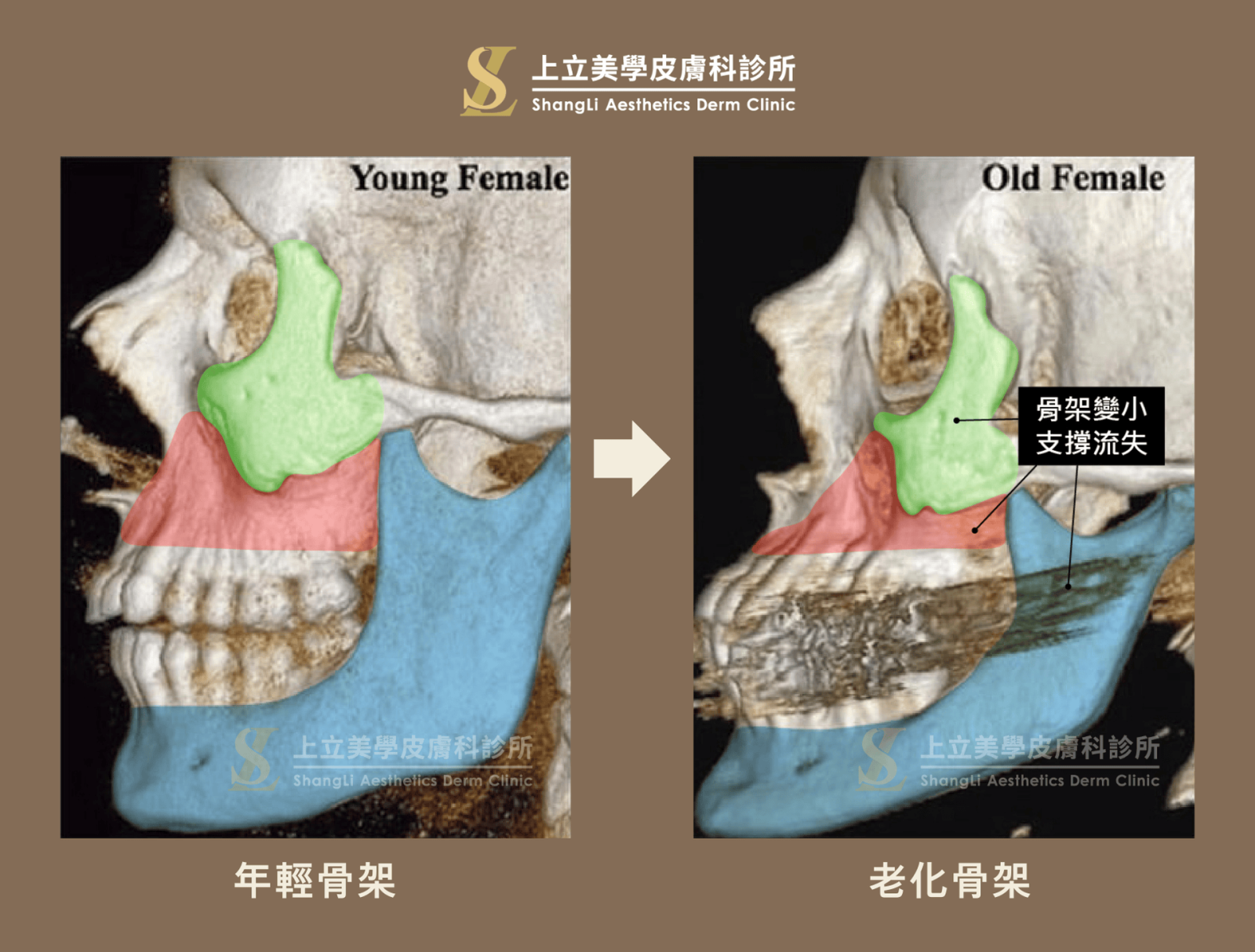 臉部骨架也會隨時間慢慢萎縮變小