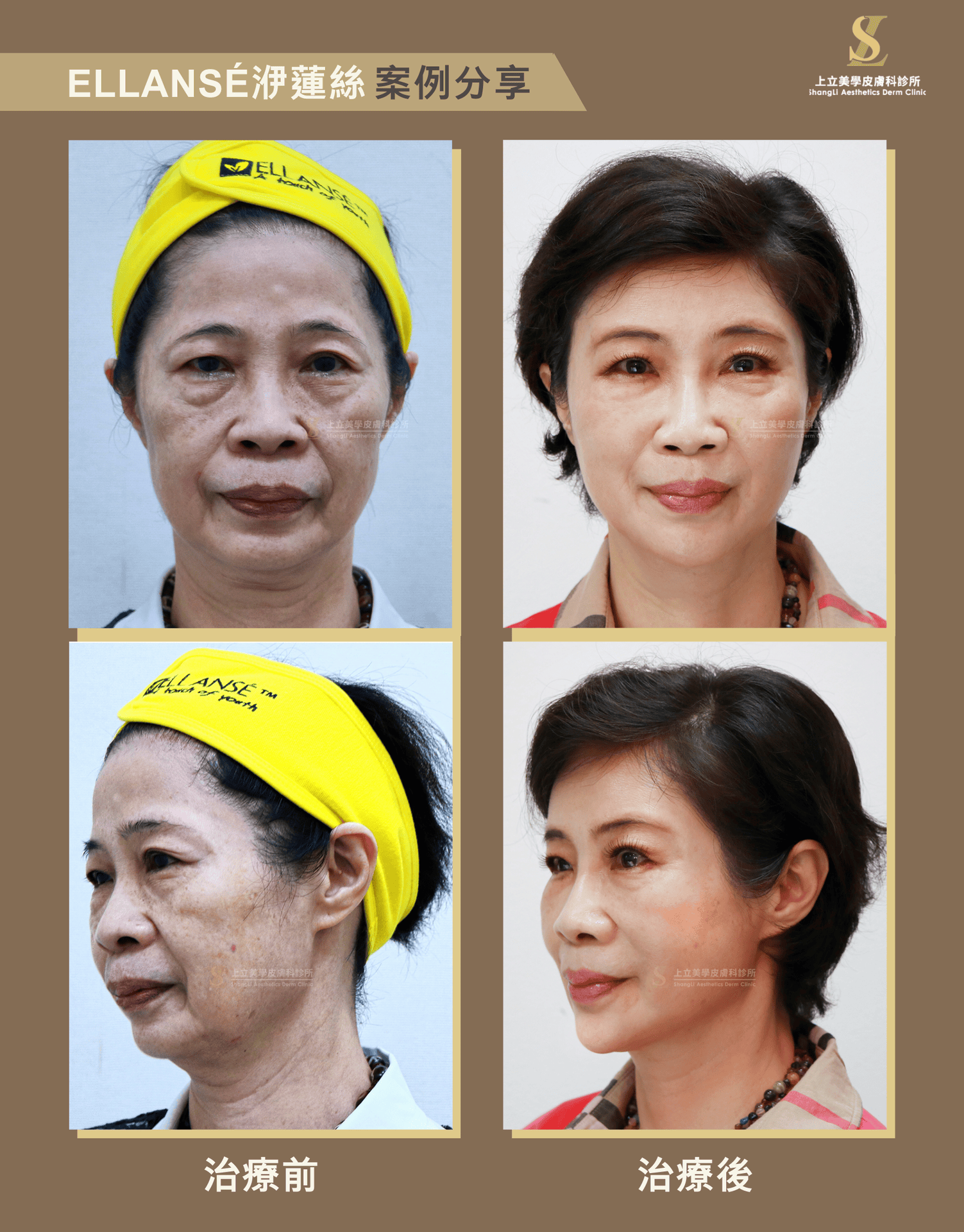 用於中下臉得支撐重現與比例調整上，ELLANS&Eacute;洢蓮絲一樣有很好的效果