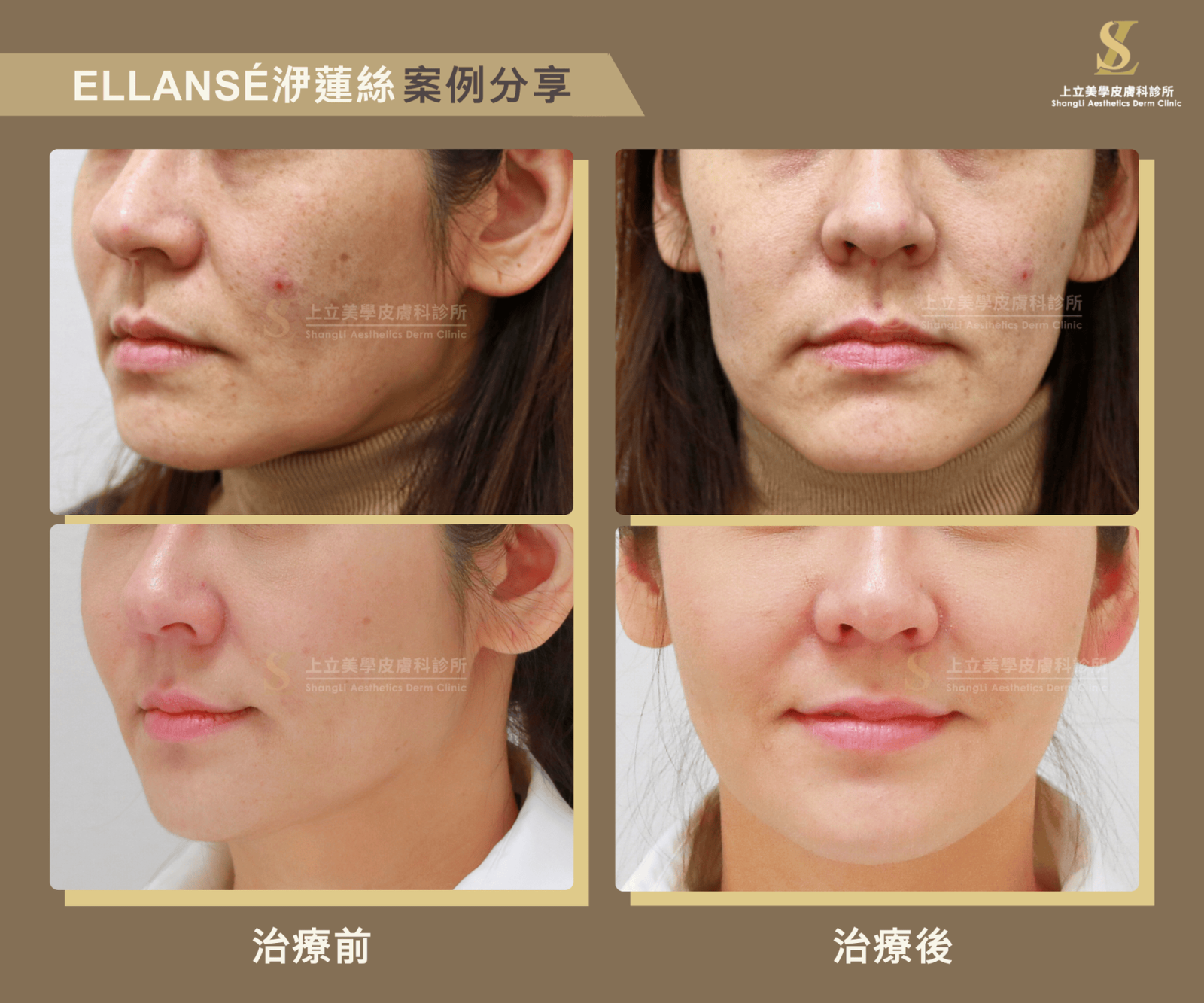 中下臉的骨架流失不僅會讓嘴邊肉鬆弛、下顎顯模糊、嘴唇變薄下垂