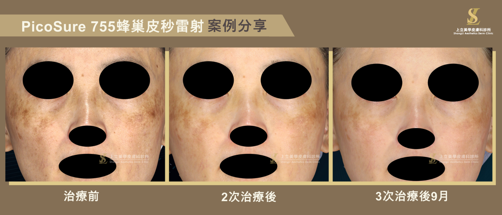 上立美學皮膚科診所，林上立醫師治療肝斑案例，使用皮秒雷射治療3次，在治療後9個月仍沒有復發情況，消除斑點的效果非常明顯