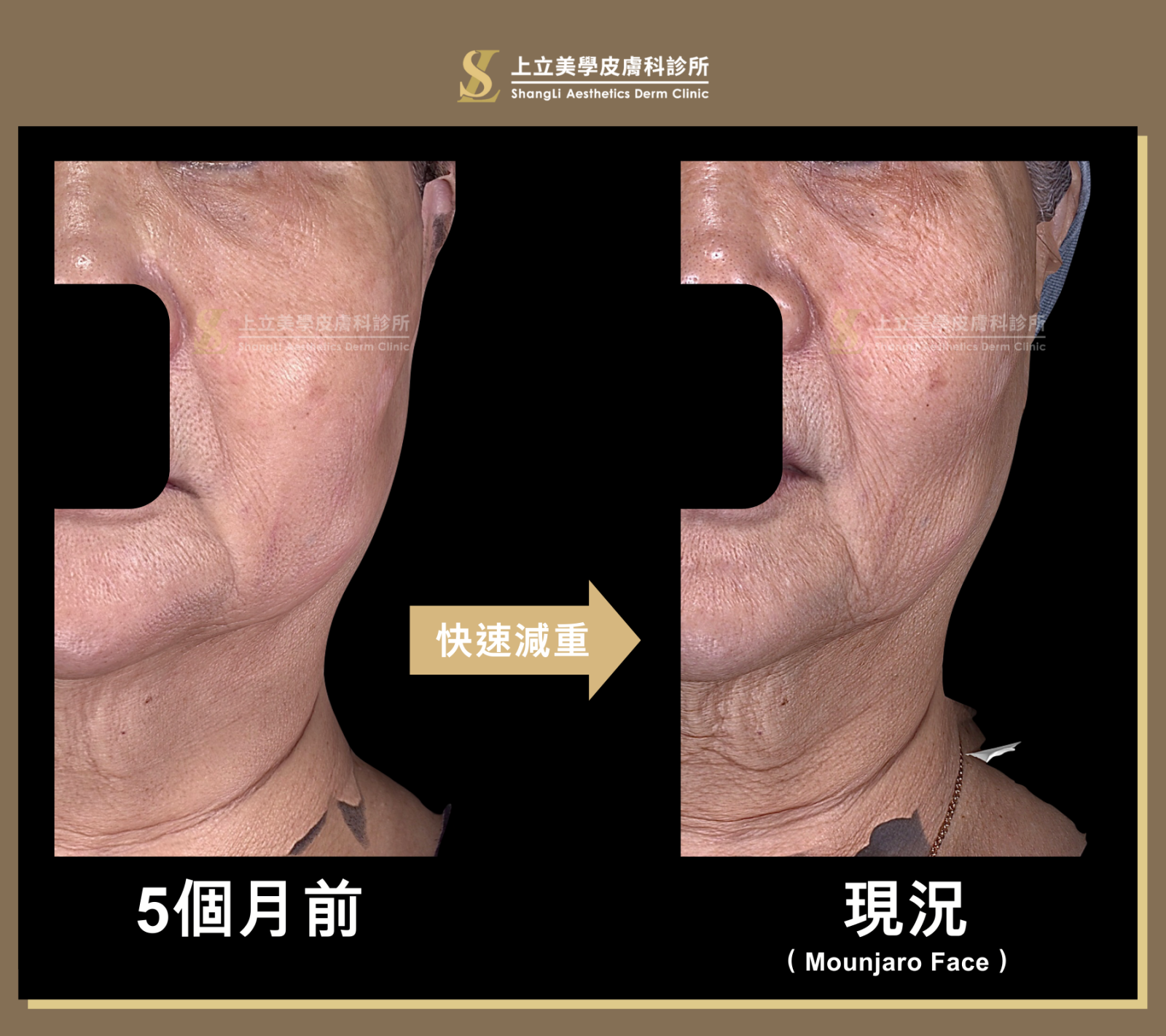 減重之前，可見一些嘴邊肉和下垂情況