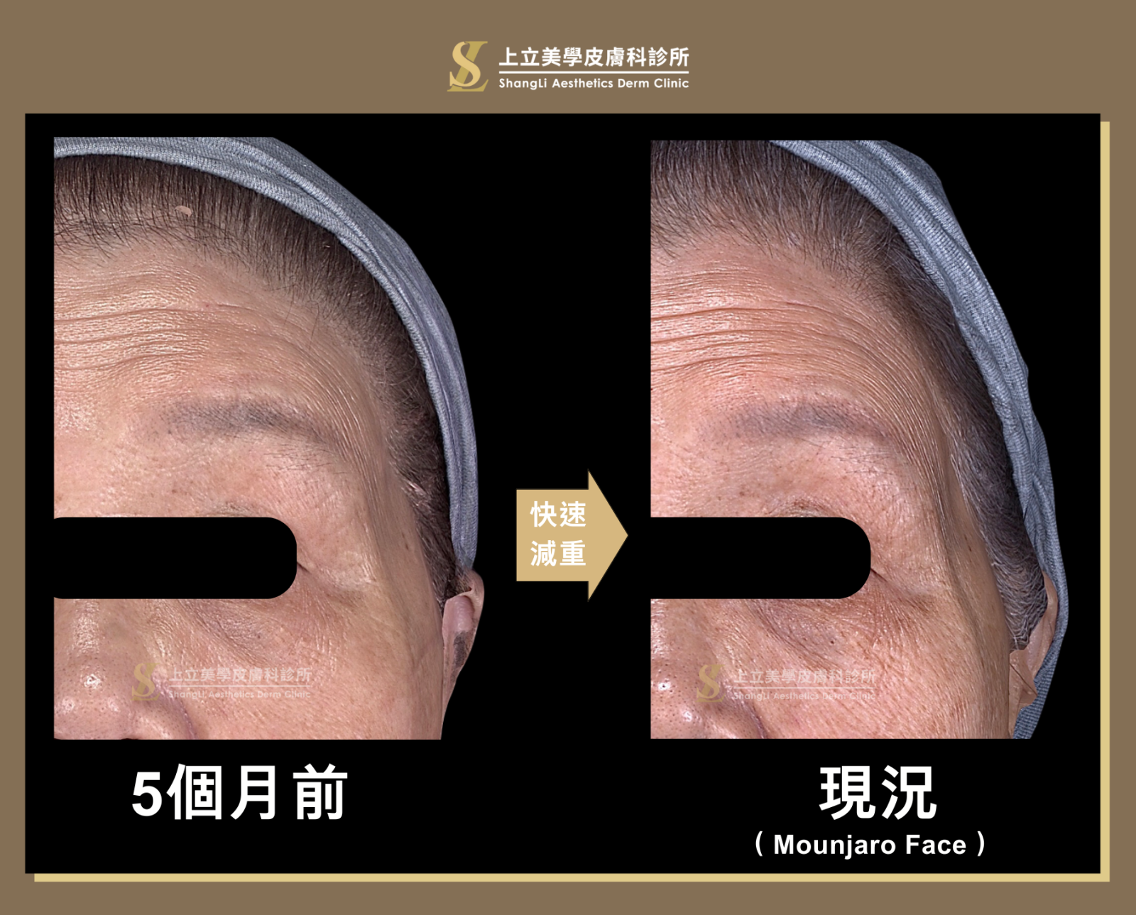 夫妻宮凹陷、眼周紋路增加、眼下淚溝陰影加深等狀況。