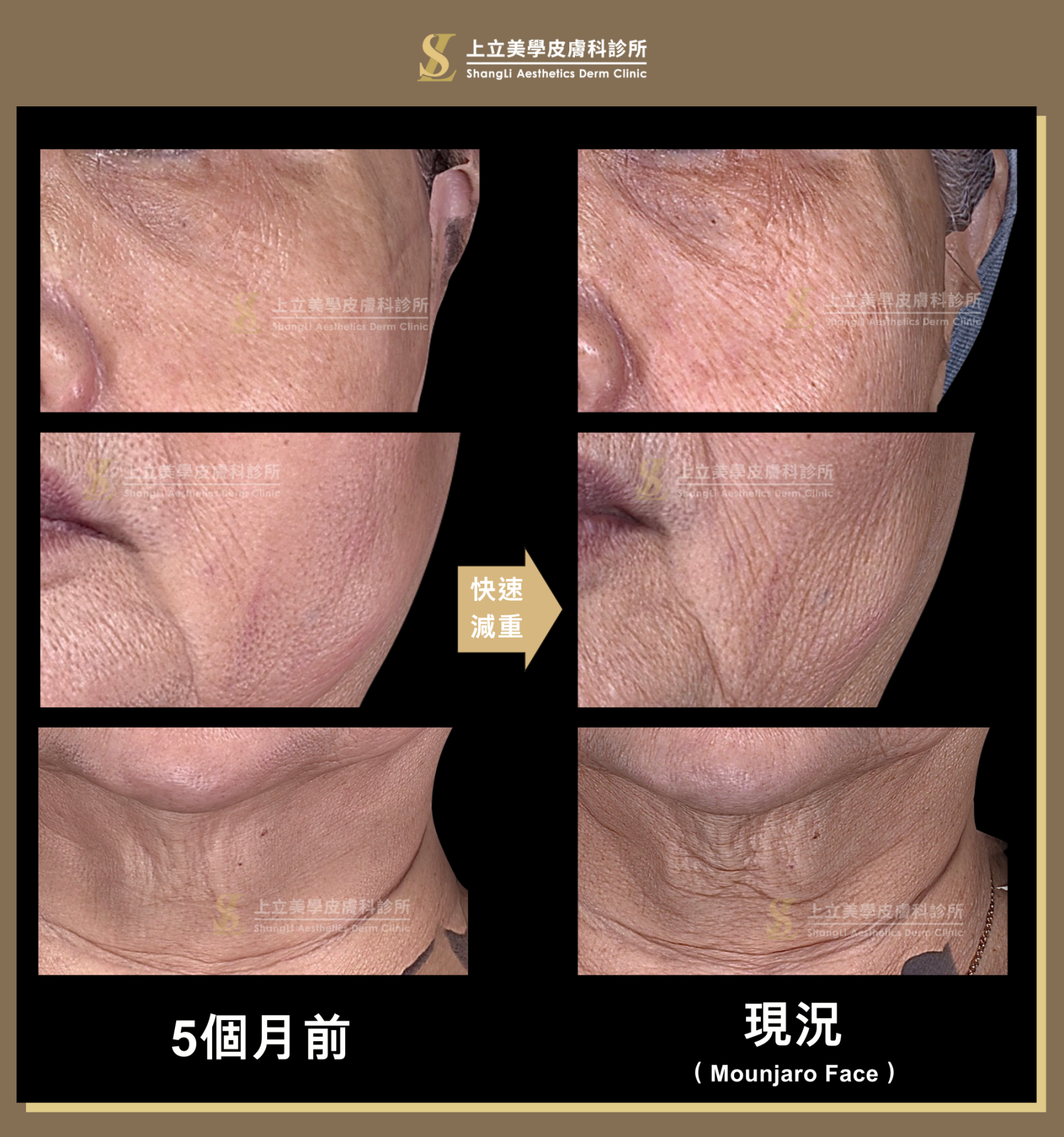 減重後的皮膚皺紋增加非常多，鬆弛情況也更嚴重。